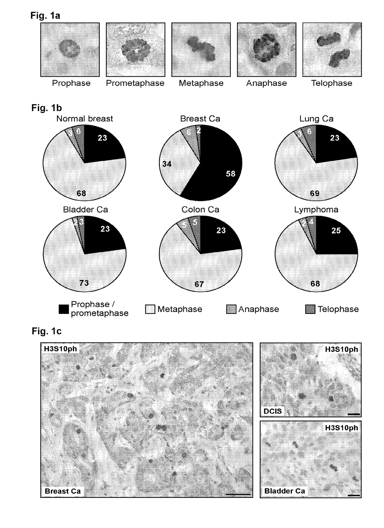 Detection and treatment of breast cancer