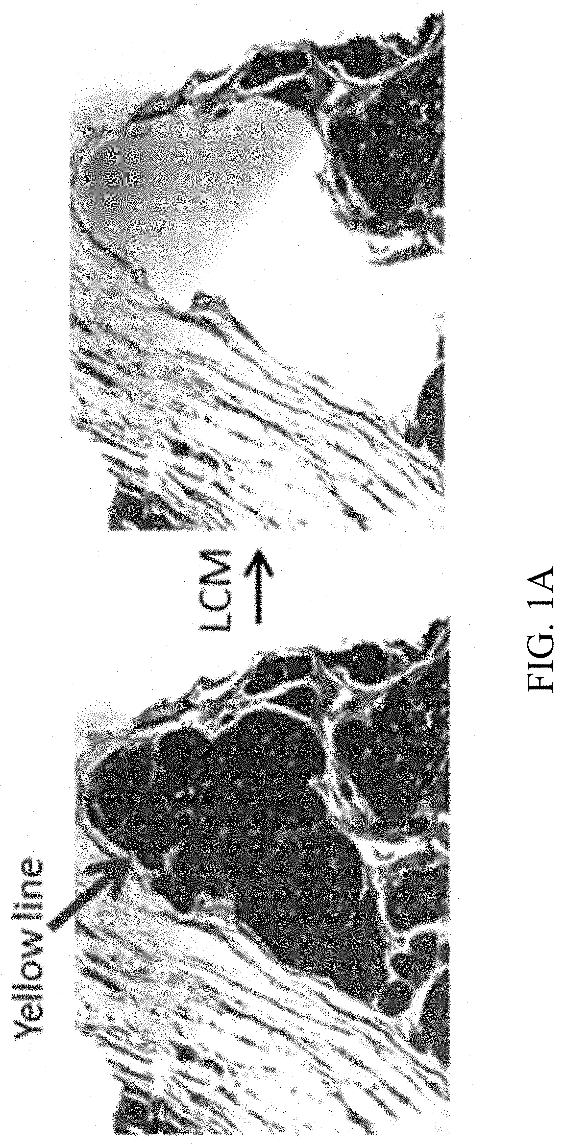 DNA methylation diagnostic test for breast cancer