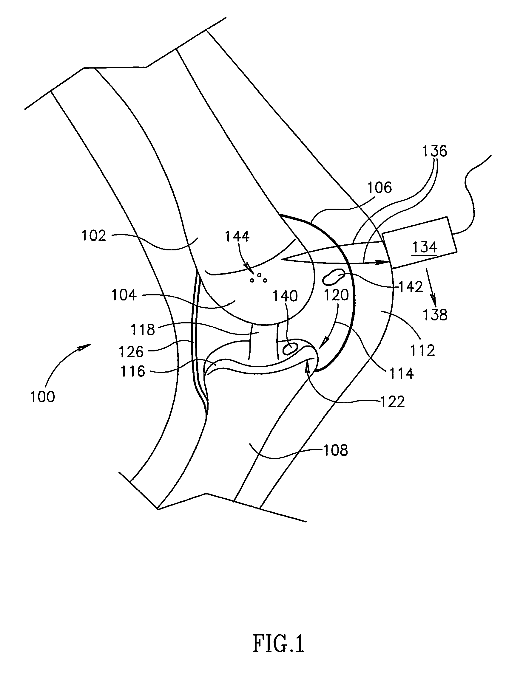 Joint analysis using ultrasound