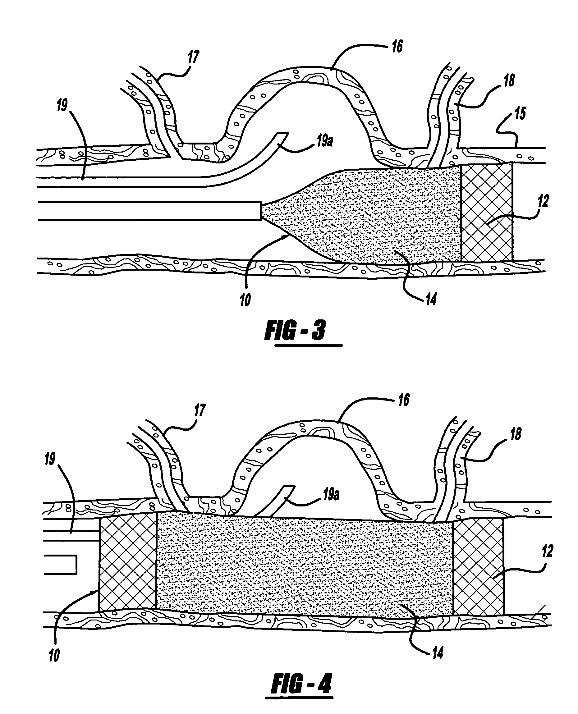 Expandable stent having a stabilized portion