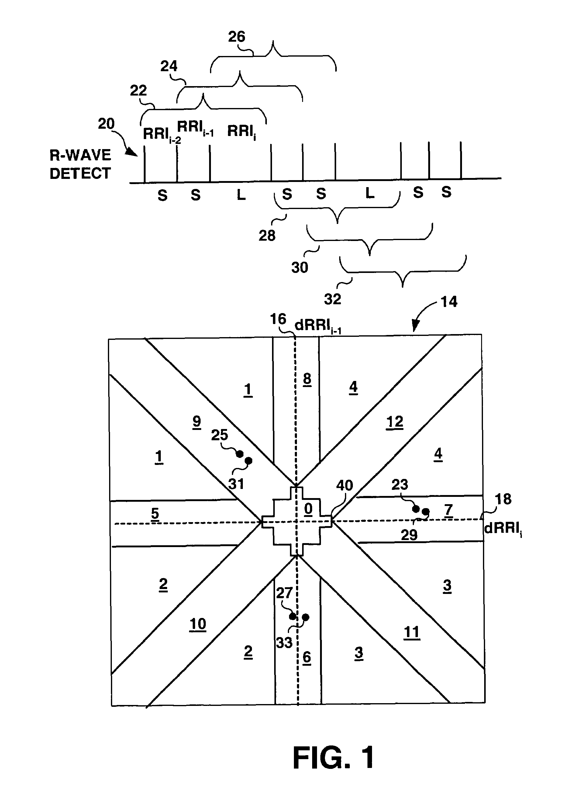 Method and apparatus for detection of tachyarrhythmia using cycle lengths