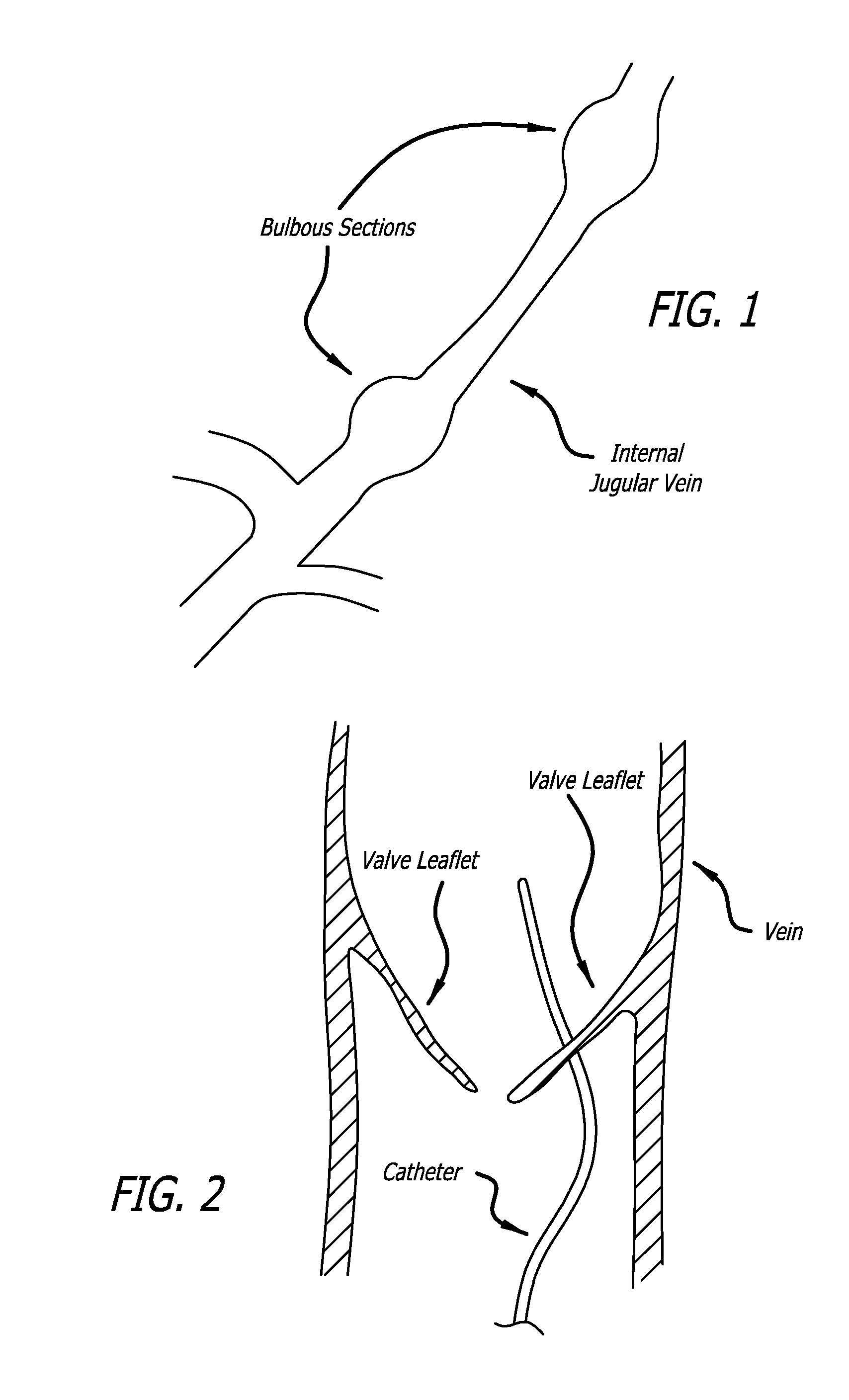 Intraluminal scaffold with conforming axial strut