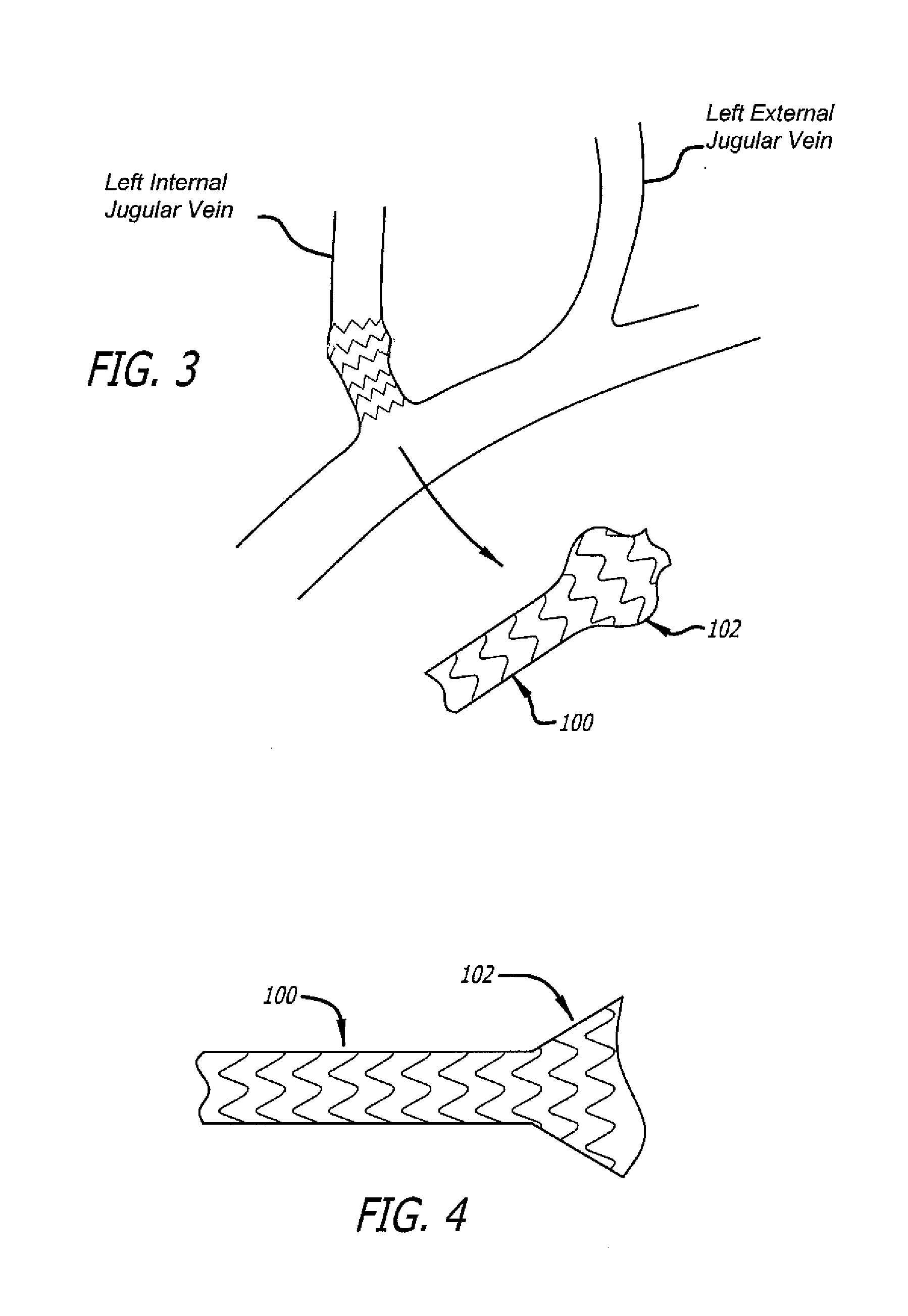 Intraluminal scaffold with conforming axial strut