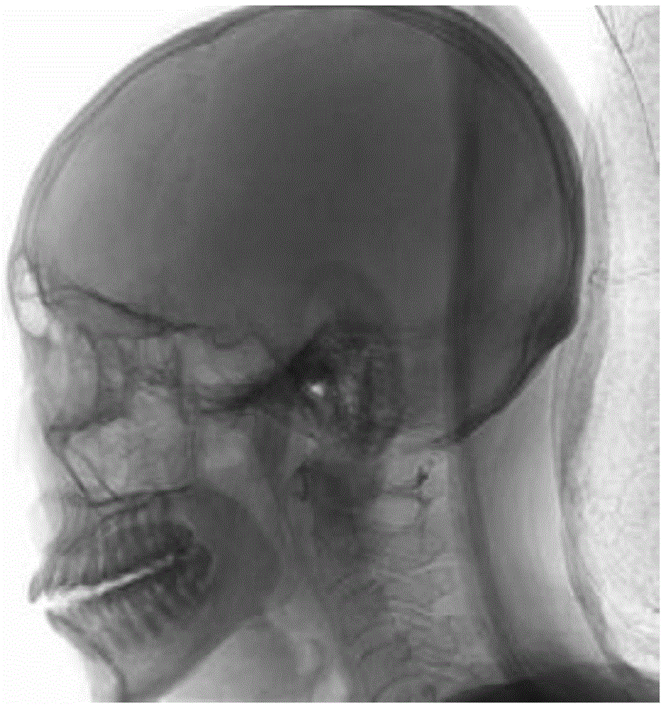 DSA Vascular Image Segmentation Method Based on Sift Feature Point Clustering and Boolean Difference Operation