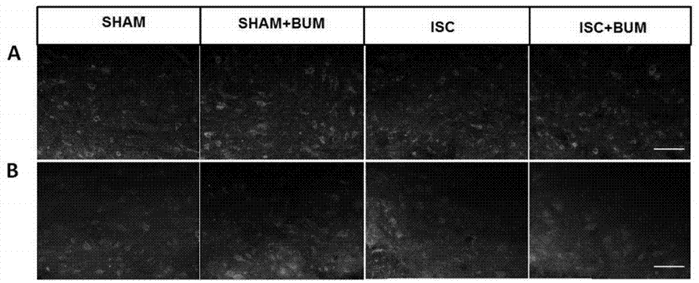 Application of bumetanide in promoting neural functional reconstruction in recovery period after ischemic stroke