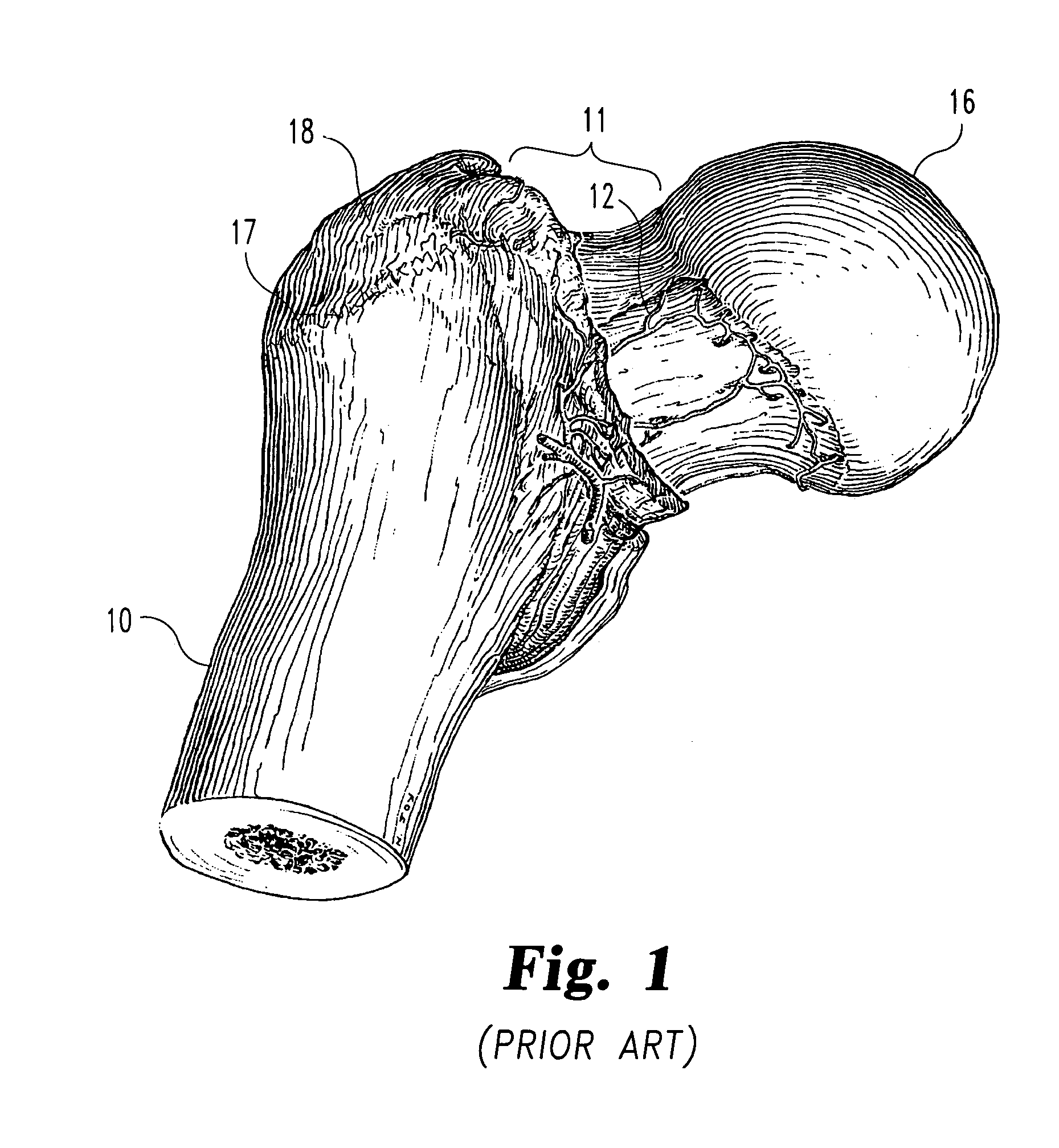 Pediatric intramedullary nail and method