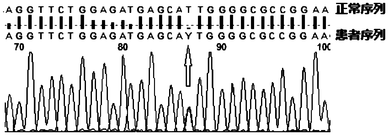 Method for determining gene mutation sites in children with pulmonary interstitial pneumonia