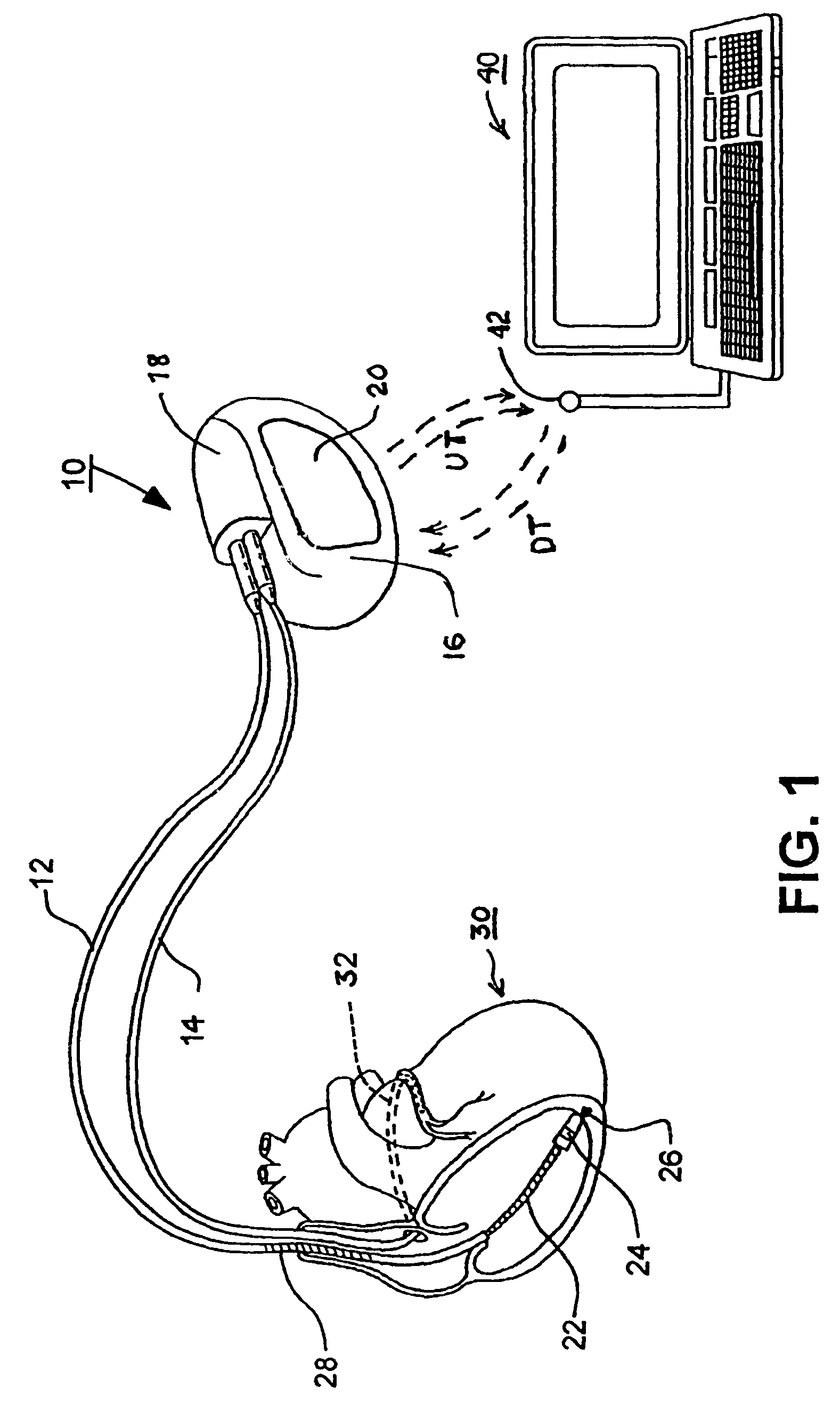 Methods and apparatus for discriminating polymorphic tachyarrhythmias from monomorphic tachyarrhythmias facilitating detection of fibrillation