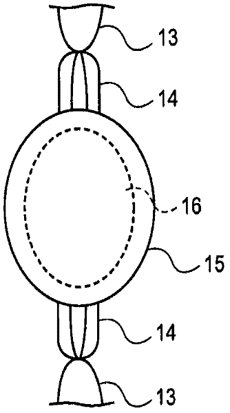 Intraocular lens and method of compensating for changes in capsule size and changes in the eye after implantation