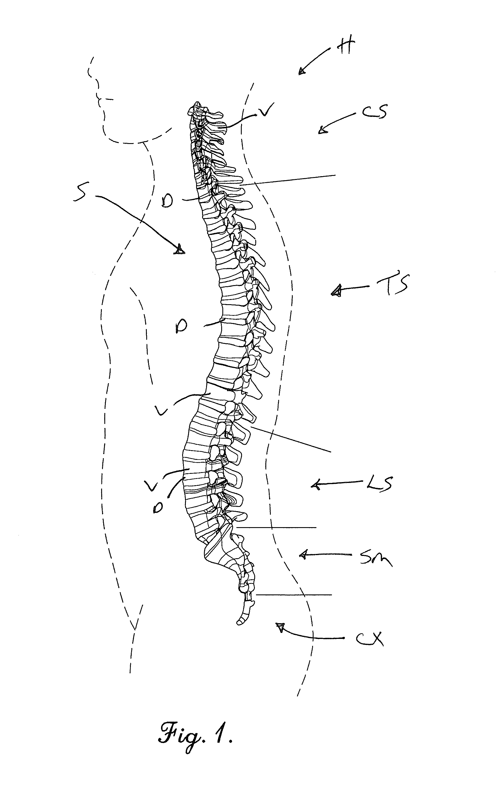 Device and method for alleviation of pain