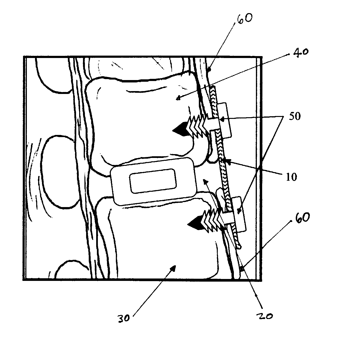 Regenerative implants for stabilizing the spine and devices for attachment of said implants