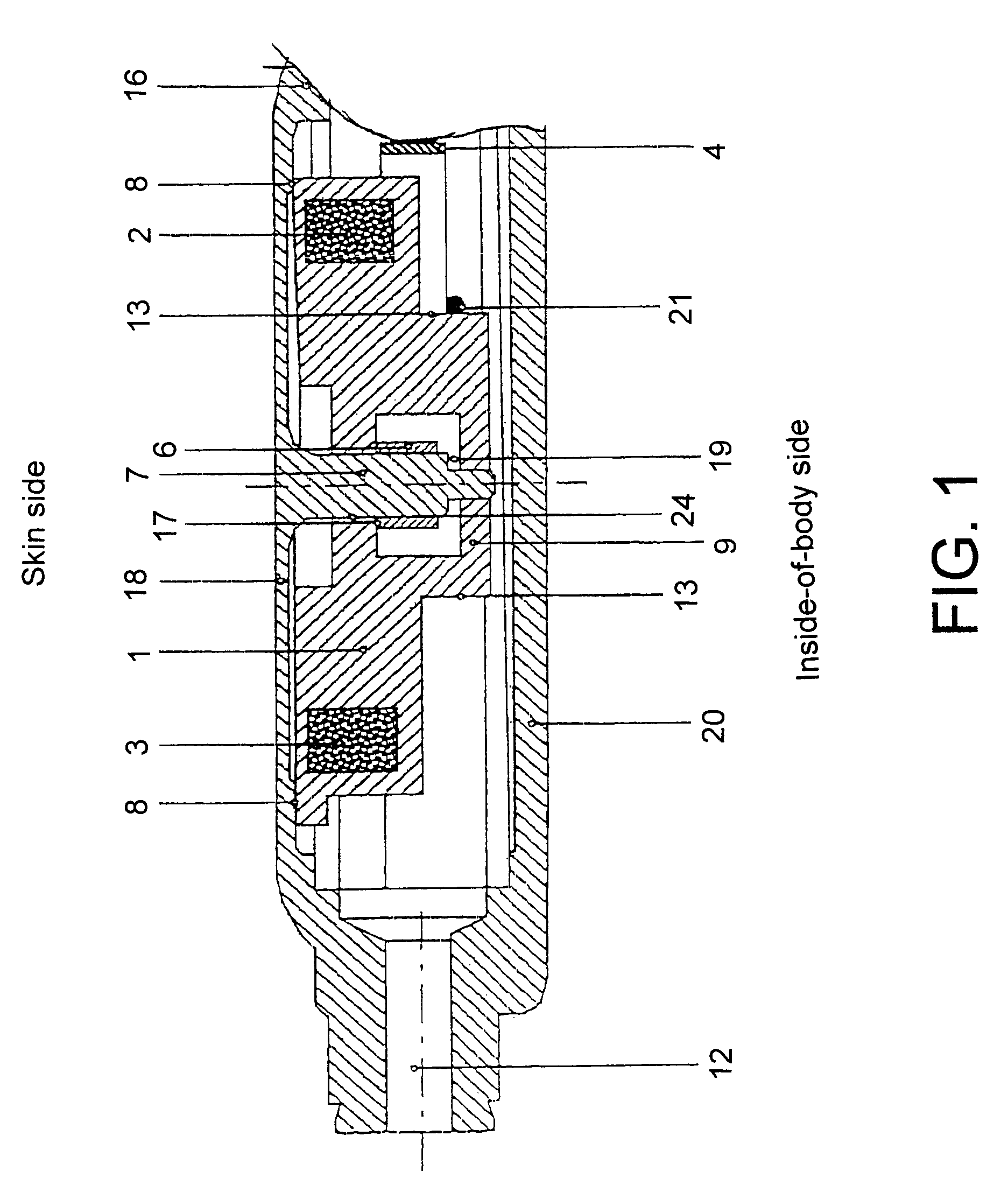 Adjustable hydrocephalus valve