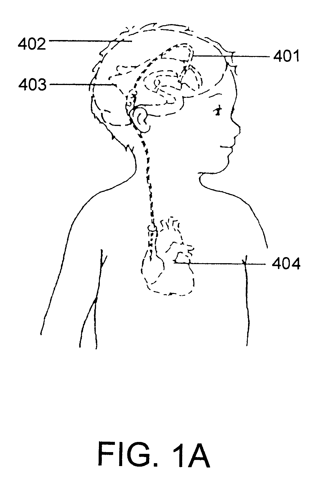 Adjustable hydrocephalus valve