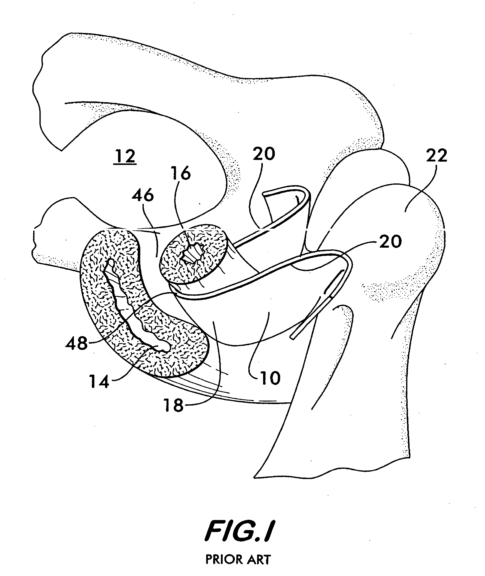 Incontinence sling