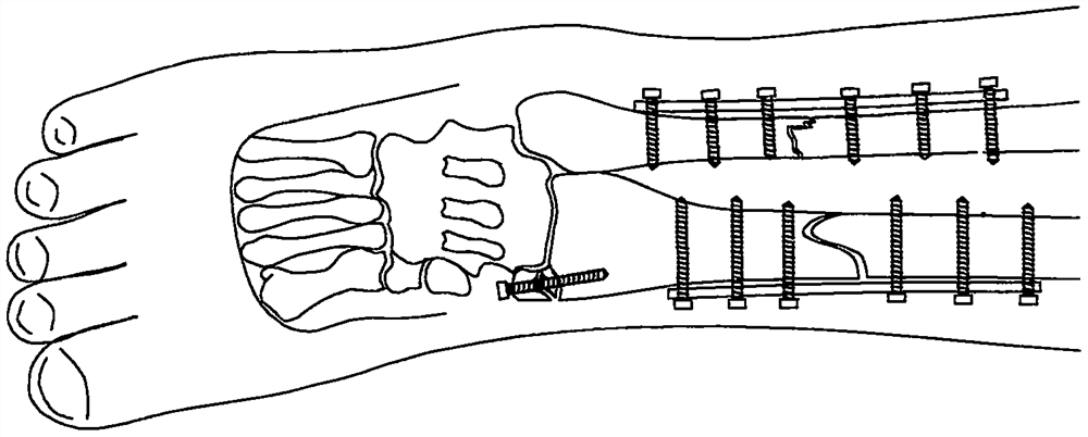 Multifunctional traction and fixing device for bone setting