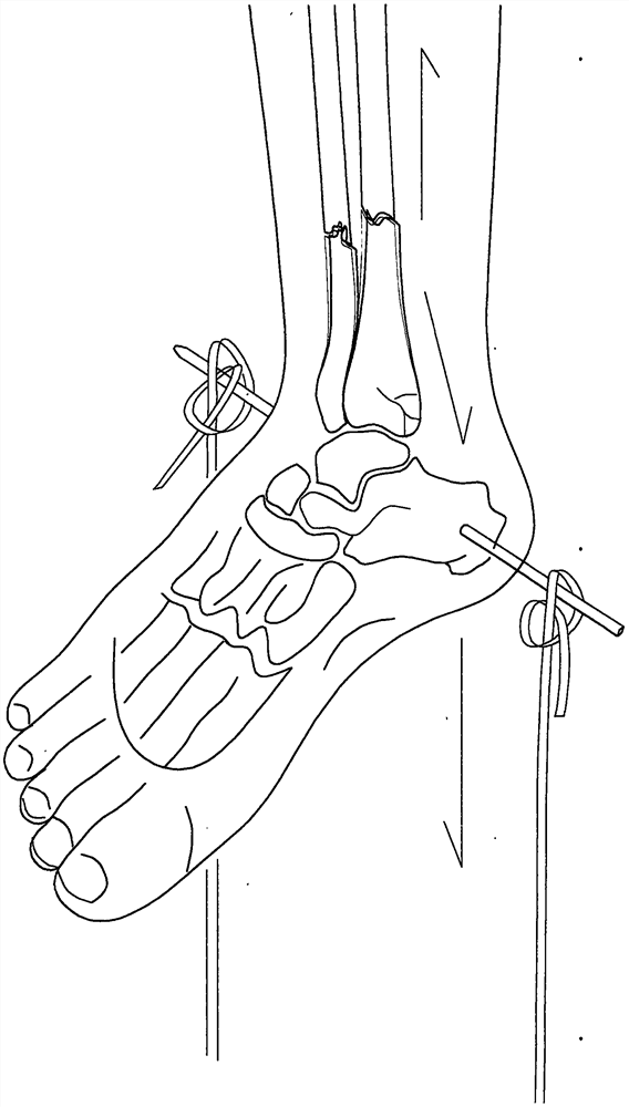 Multifunctional traction and fixing device for bone setting