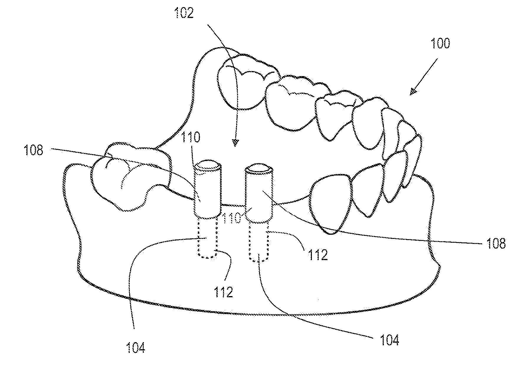 Method for making and using a template for locating a dental implant and components relating thereto