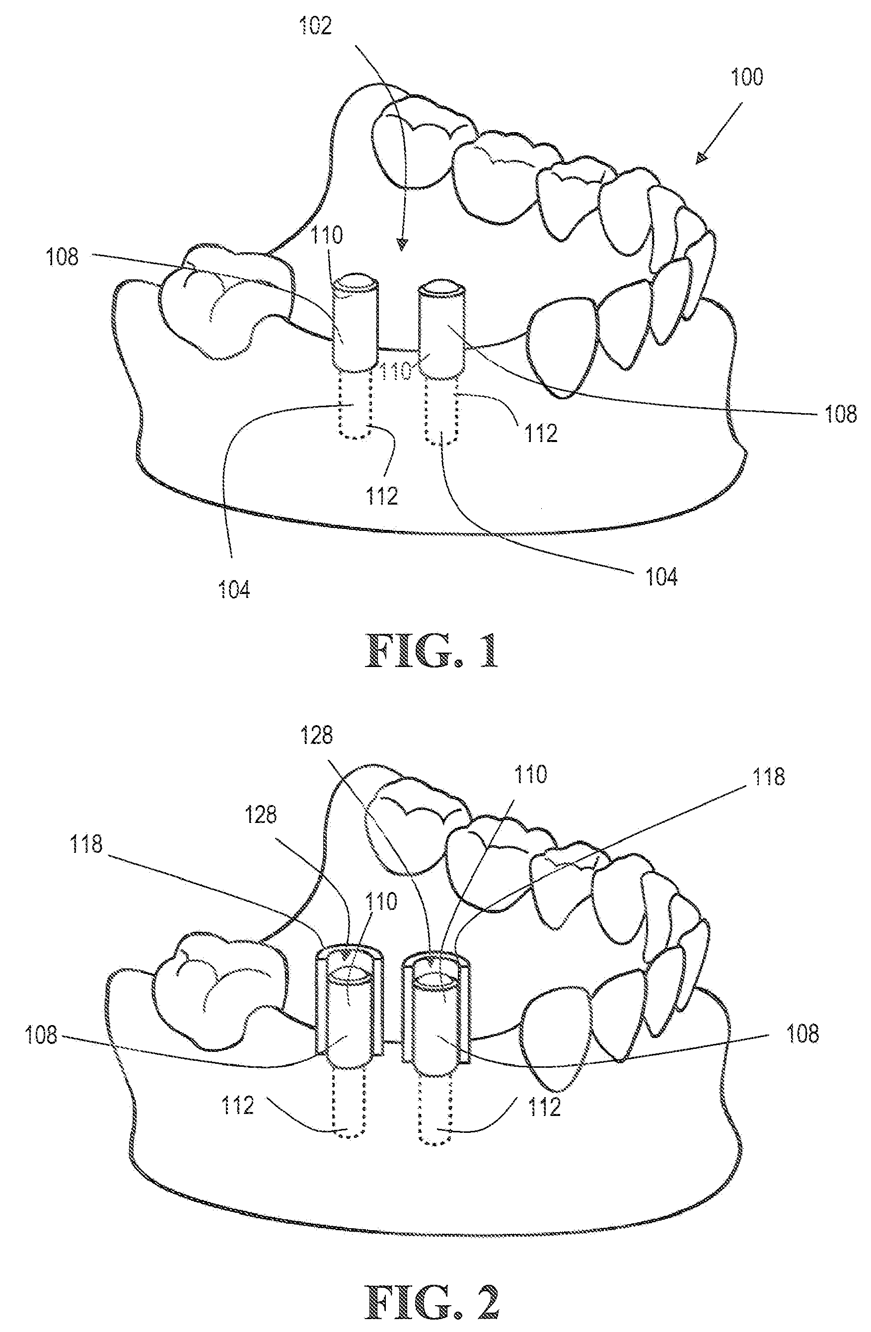 Method for making and using a template for locating a dental implant and components relating thereto