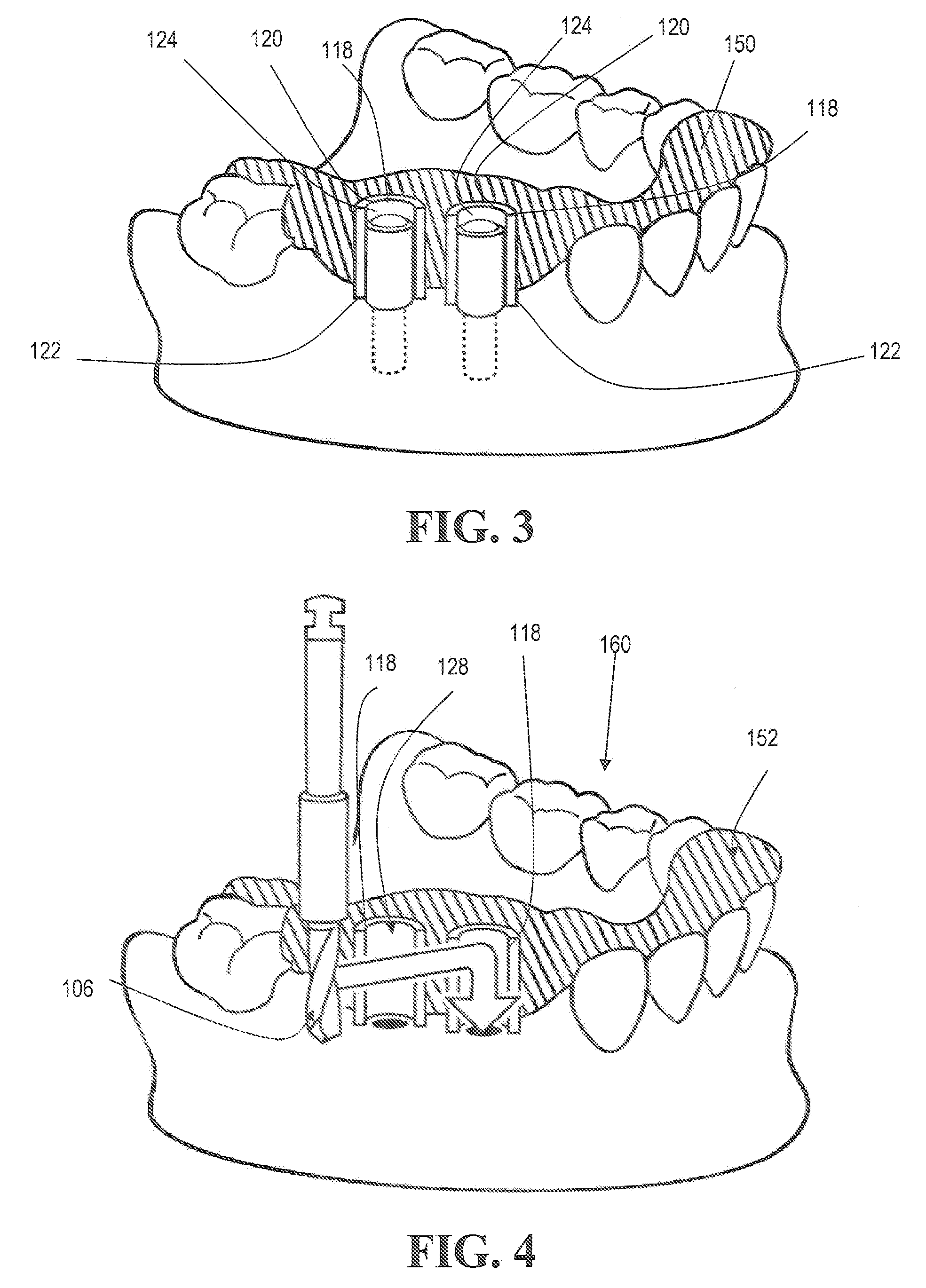 Method for making and using a template for locating a dental implant and components relating thereto