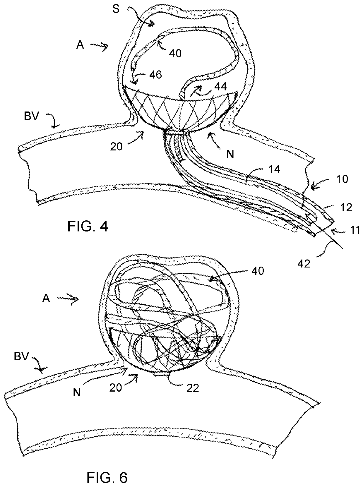 Aneurysm occlusion device