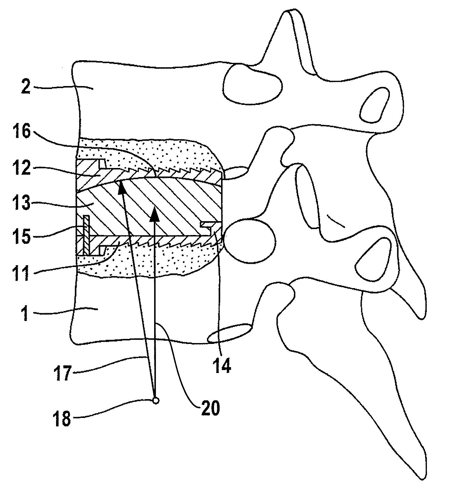 Cervical intervertebral prosthesis system