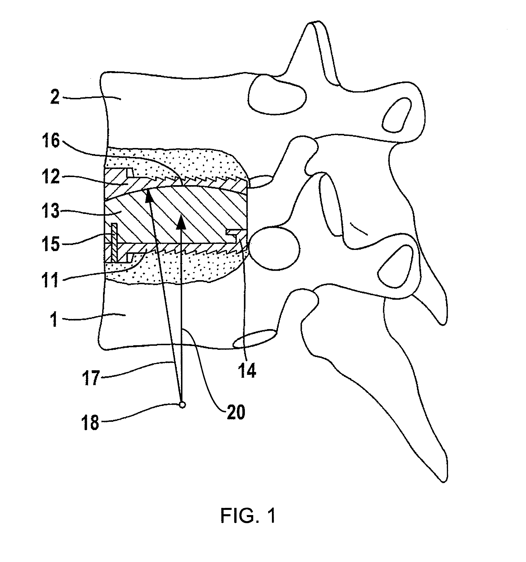 Cervical intervertebral prosthesis system