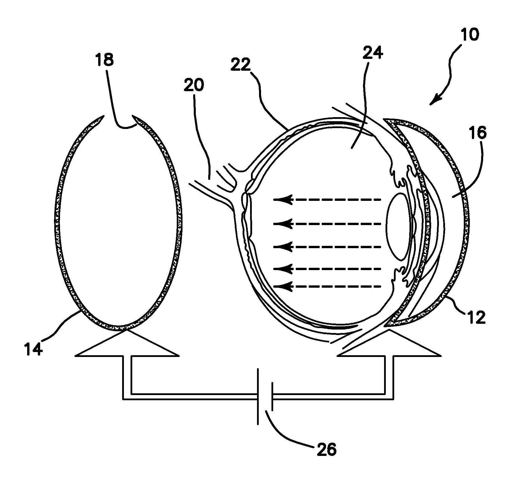 Method and apparatus for optogenetic treatment of blindness including retinitis pigmentosa