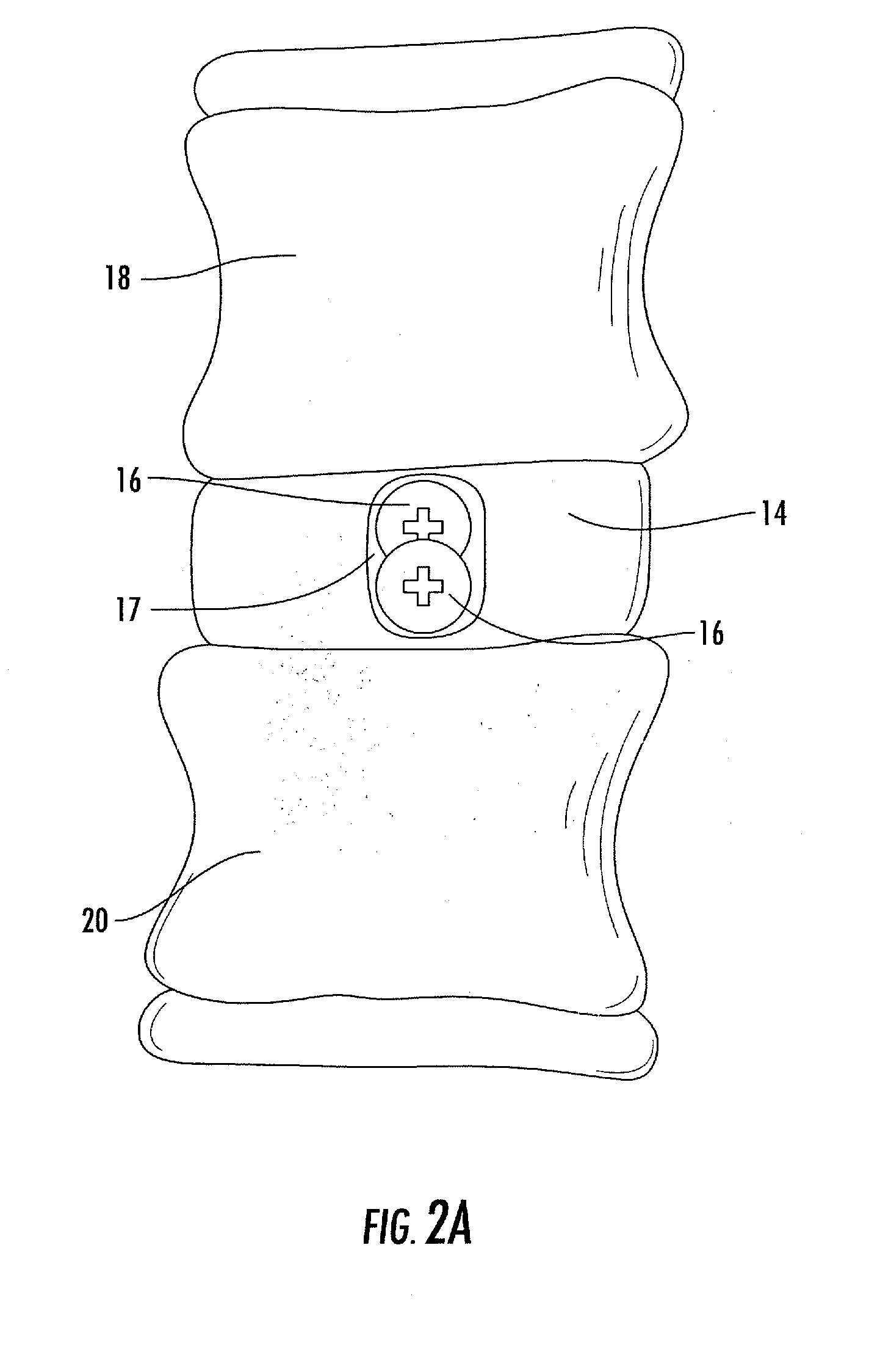 Interbody fusion system with intervertebral implant retention assembly