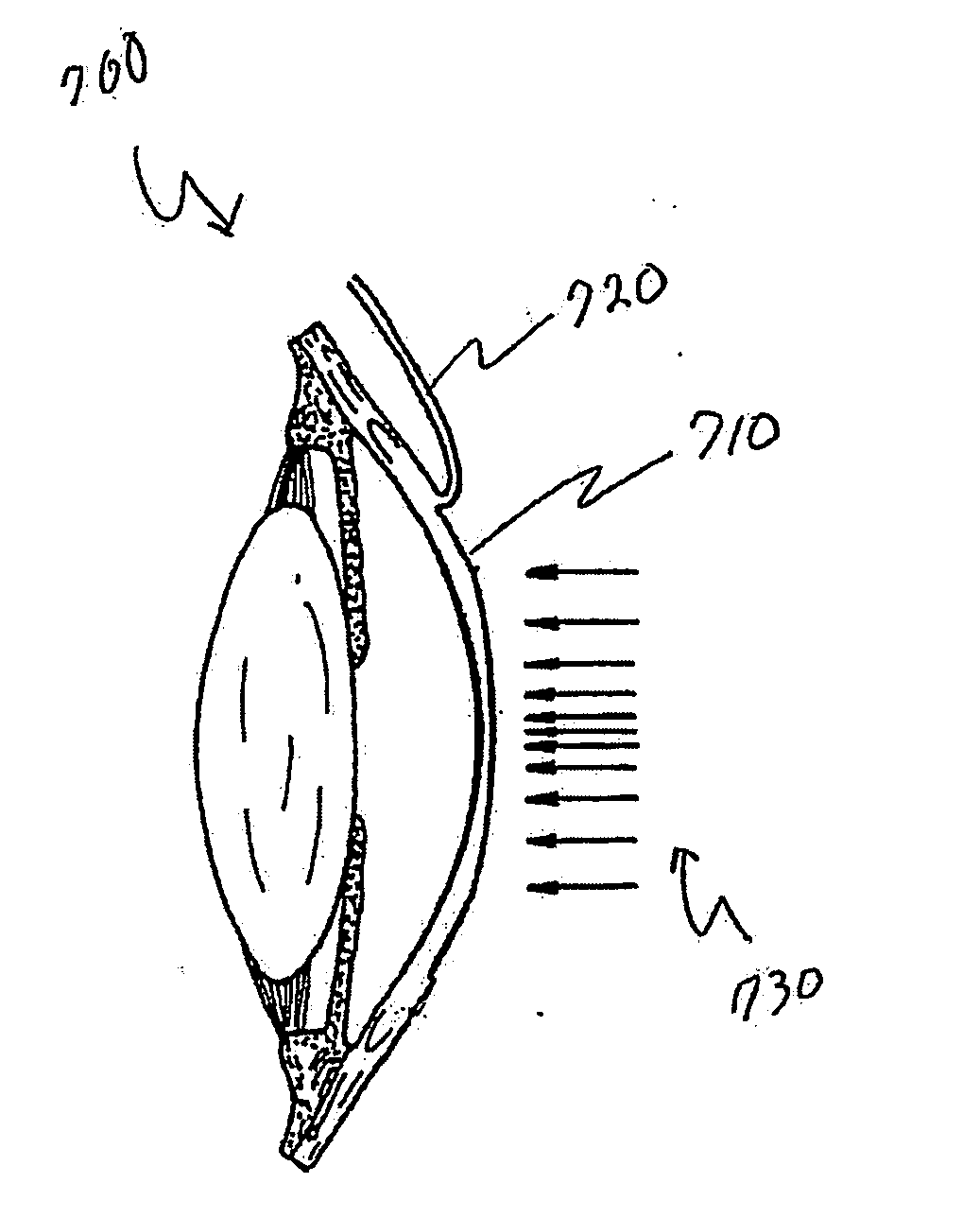 Mazaheri lasik method for visual enhancement