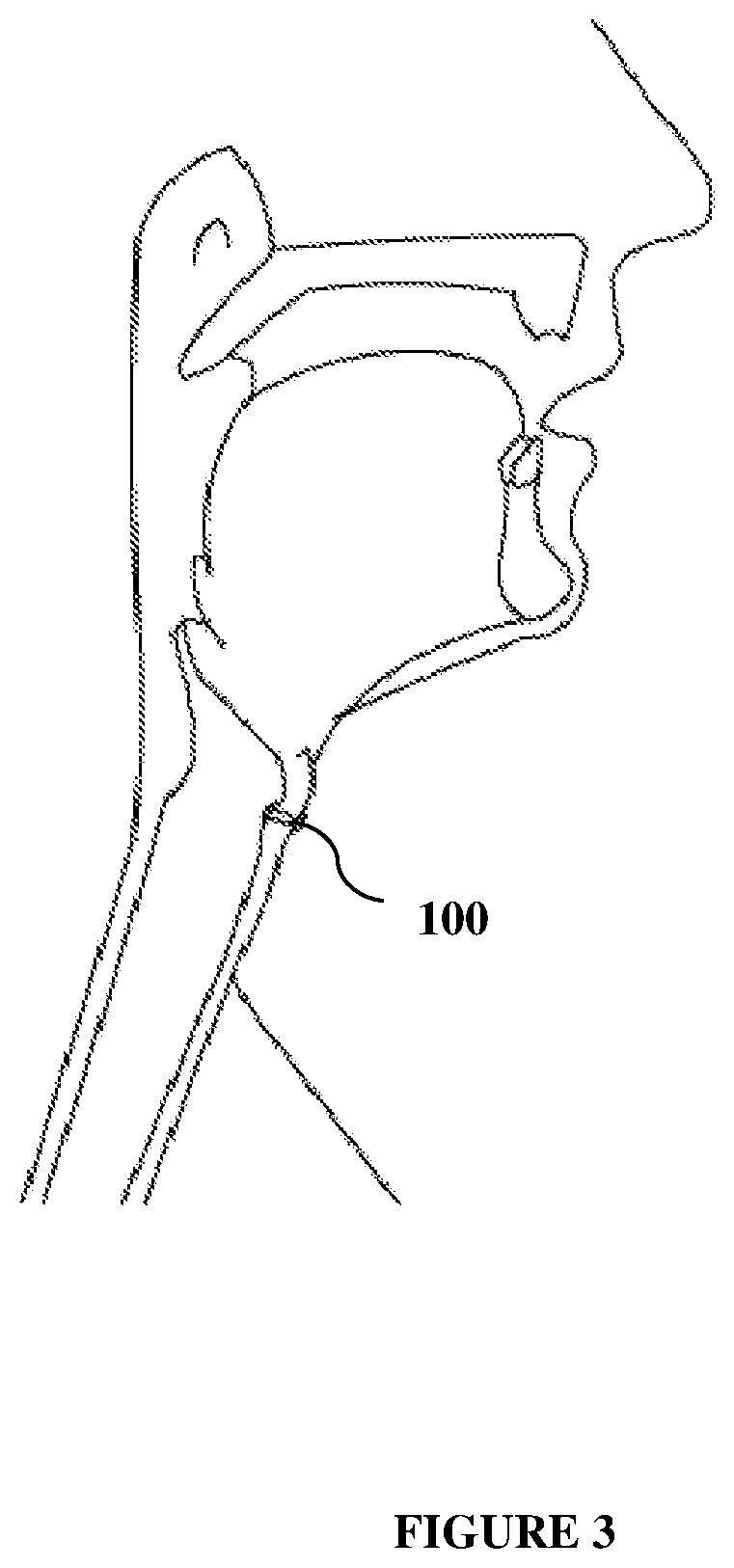 Trachea esophageal voice prosthesis