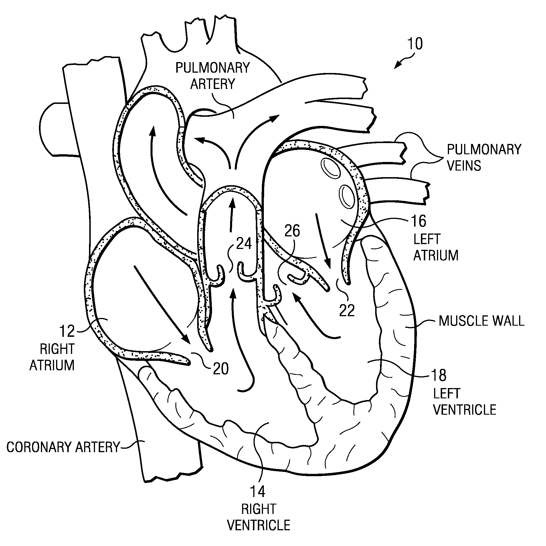 Valve for ventricular assist device