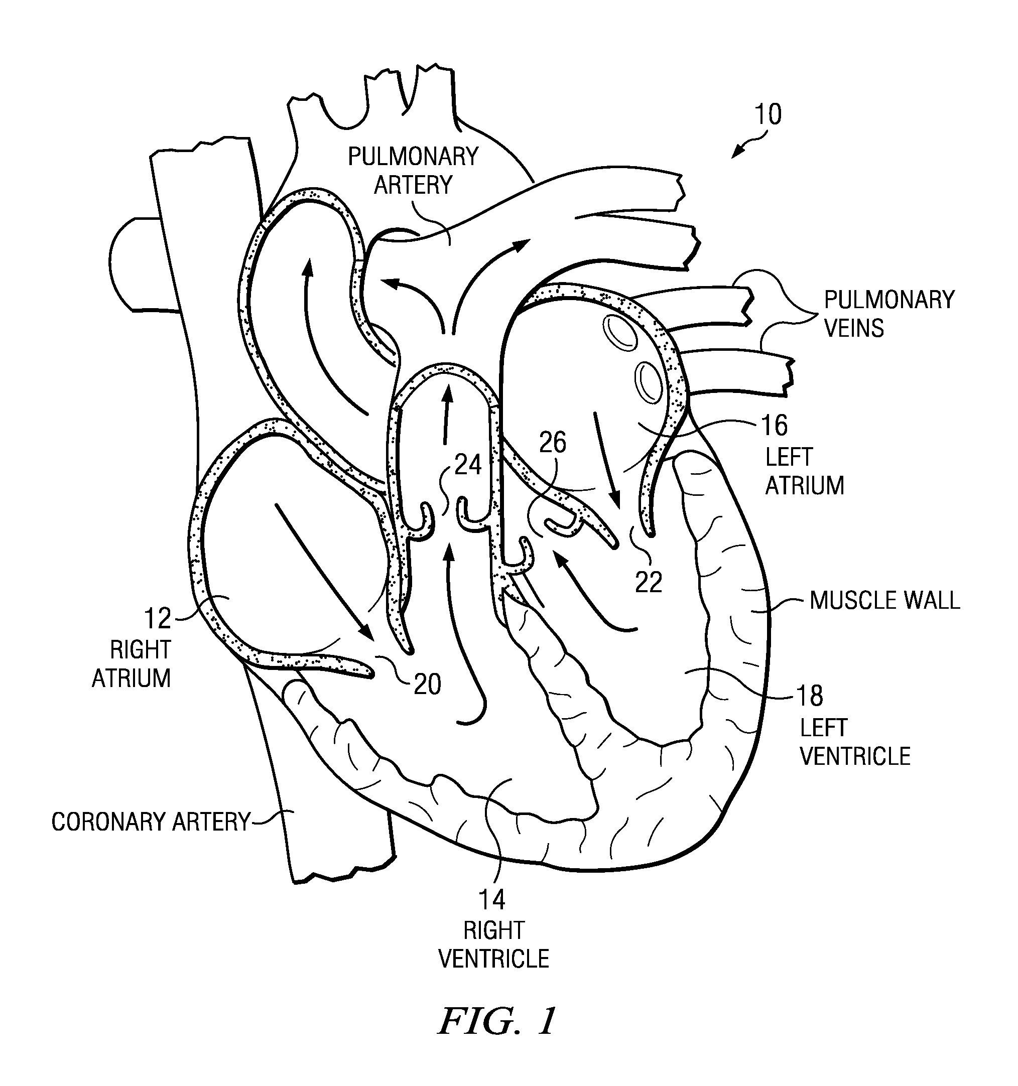 Valve for ventricular assist device