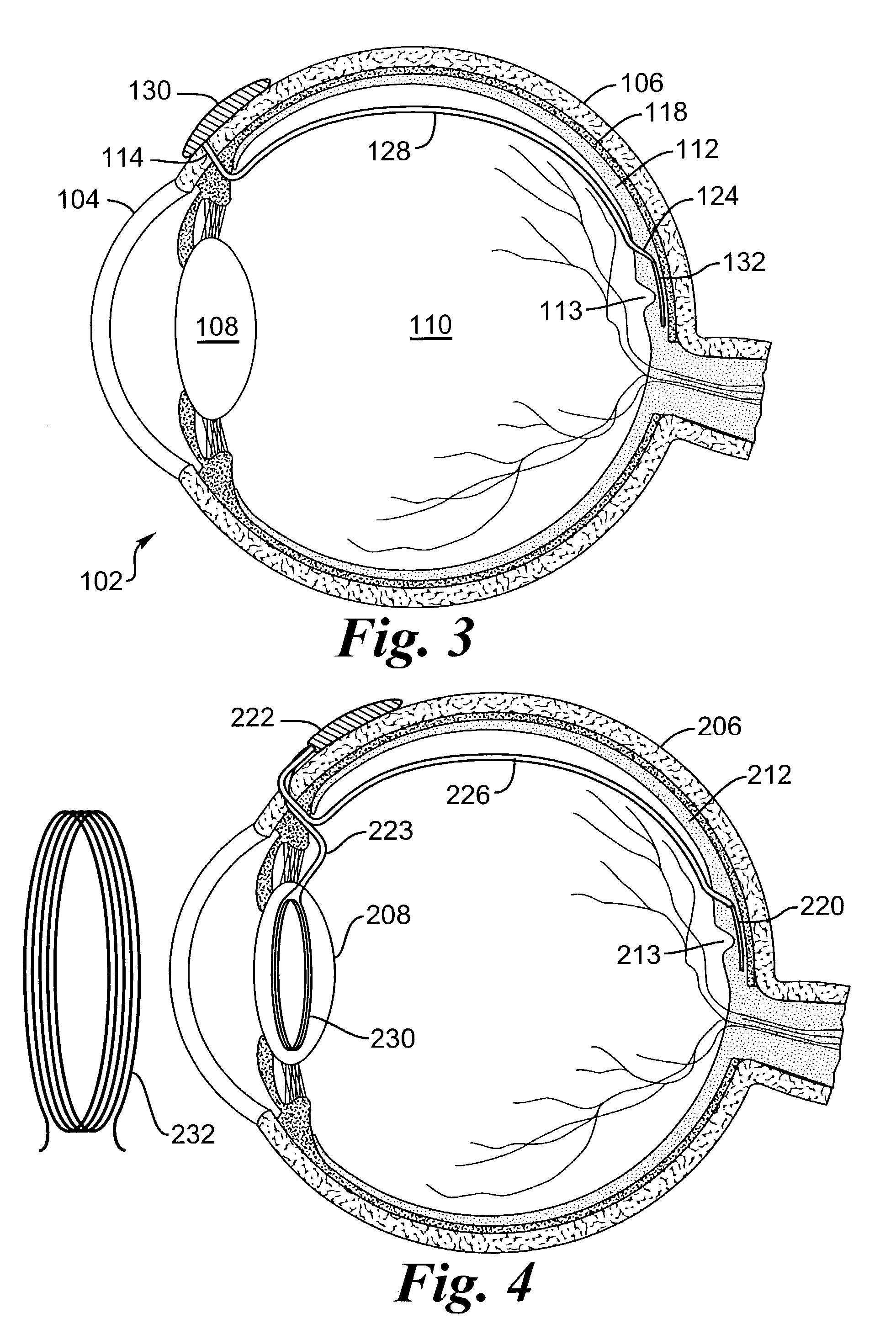 Transretinal implant and method of implantation