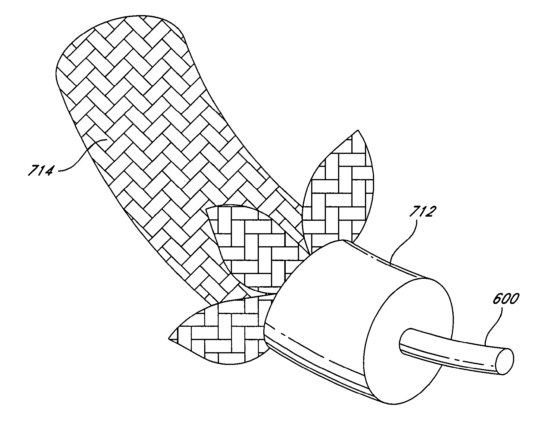 Intraoperative and post-operative adjustment of an annuloplasty ring