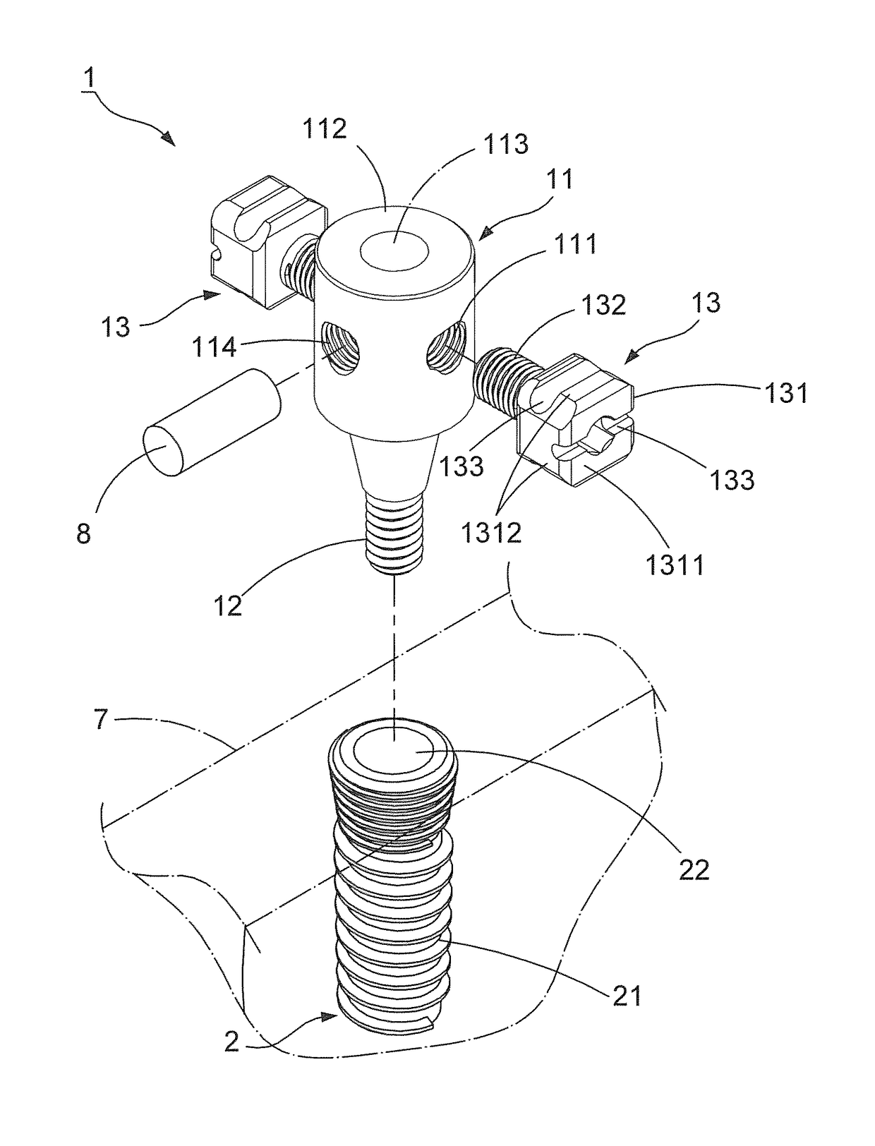 Orthodontic structure capable of implanting implants and straightening teeth