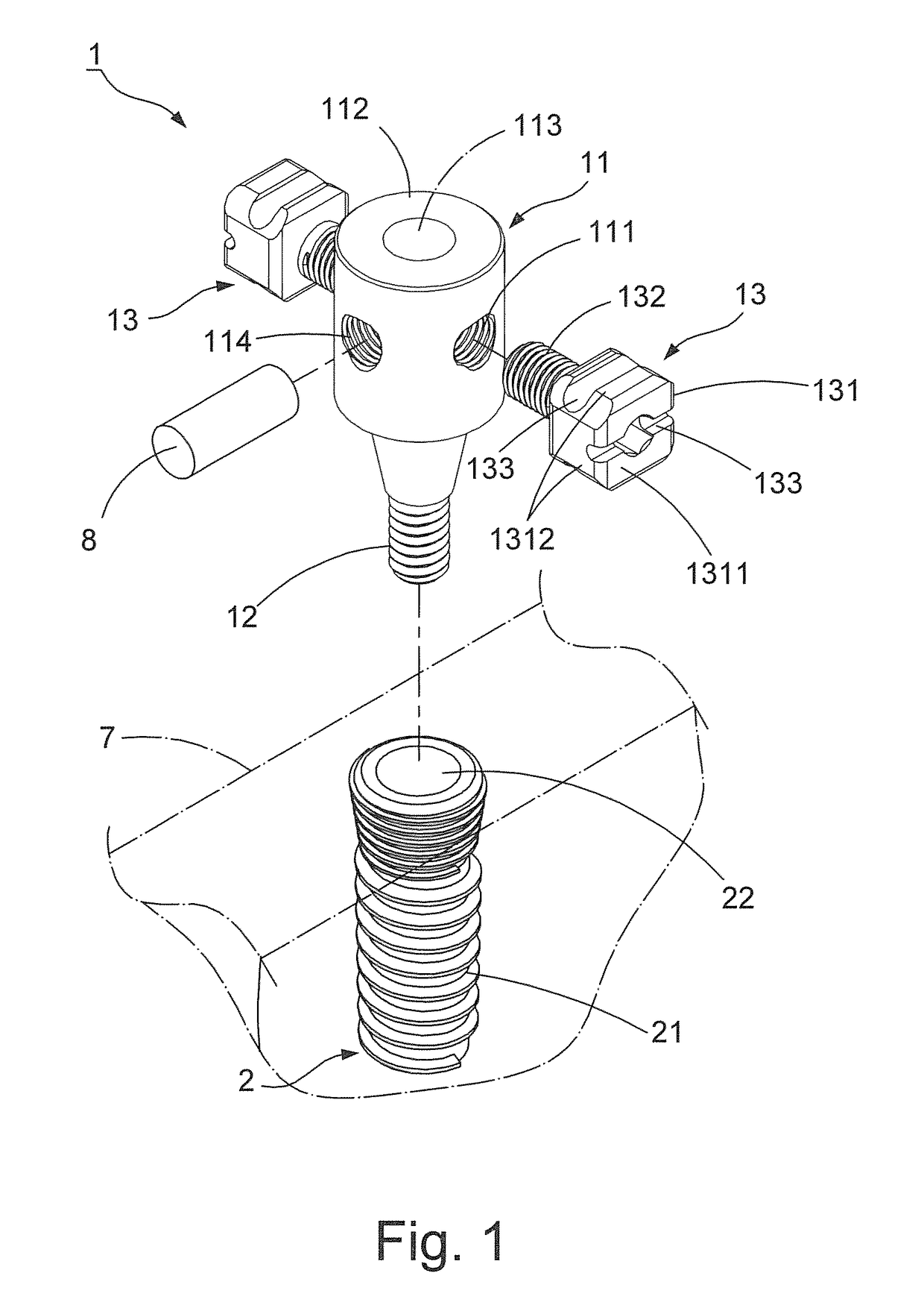 Orthodontic structure capable of implanting implants and straightening teeth