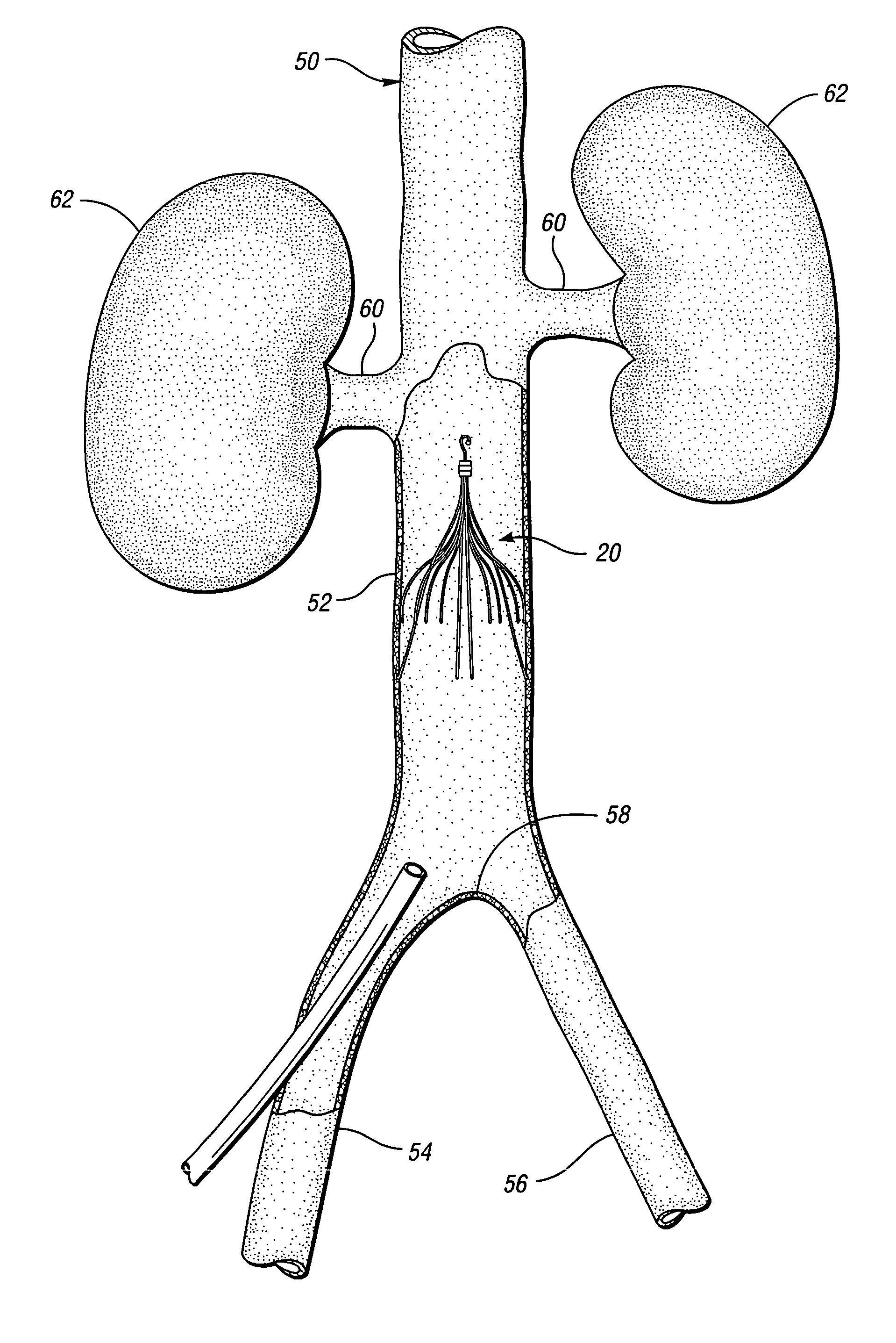 Removable vena cava filter