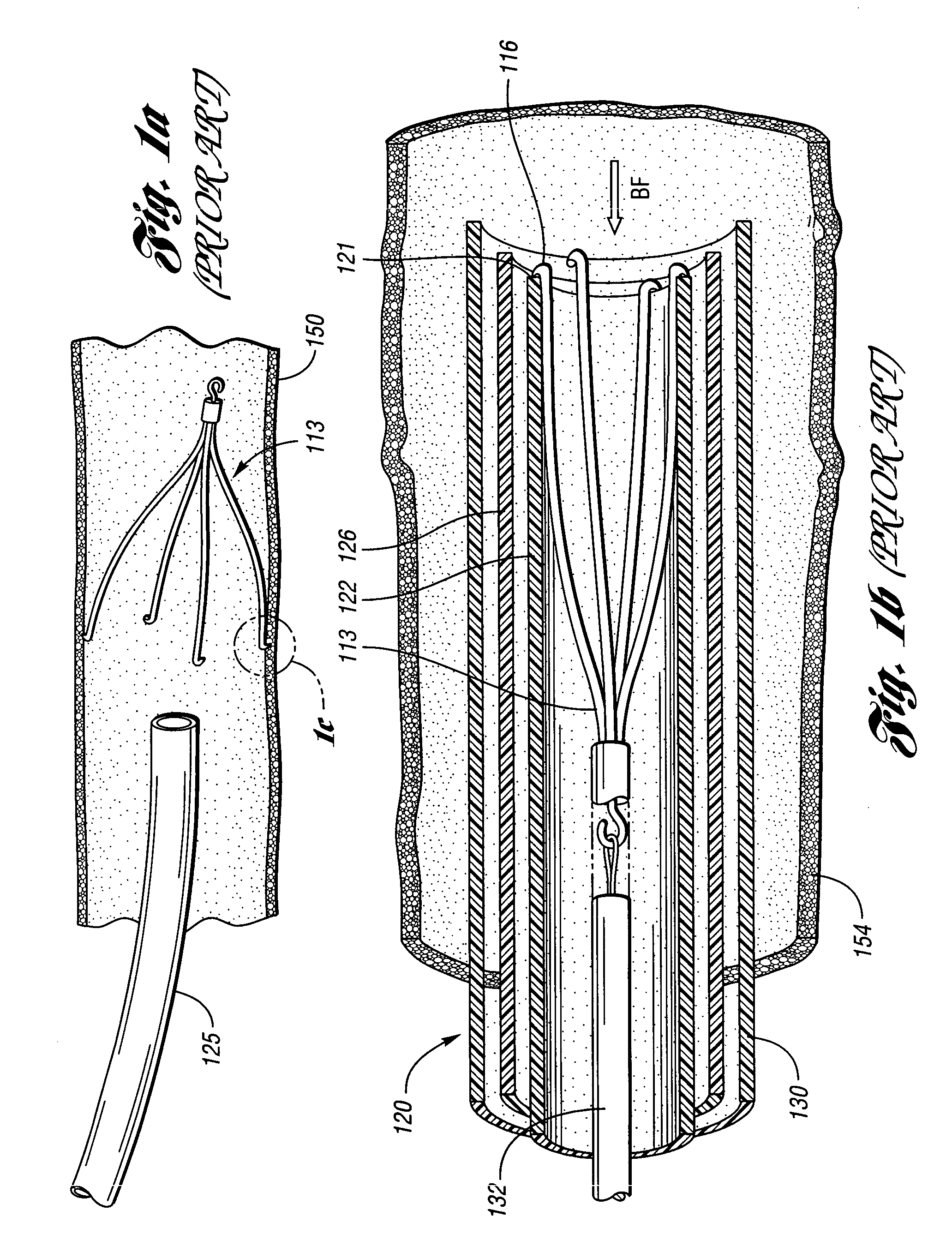 Removable vena cava filter