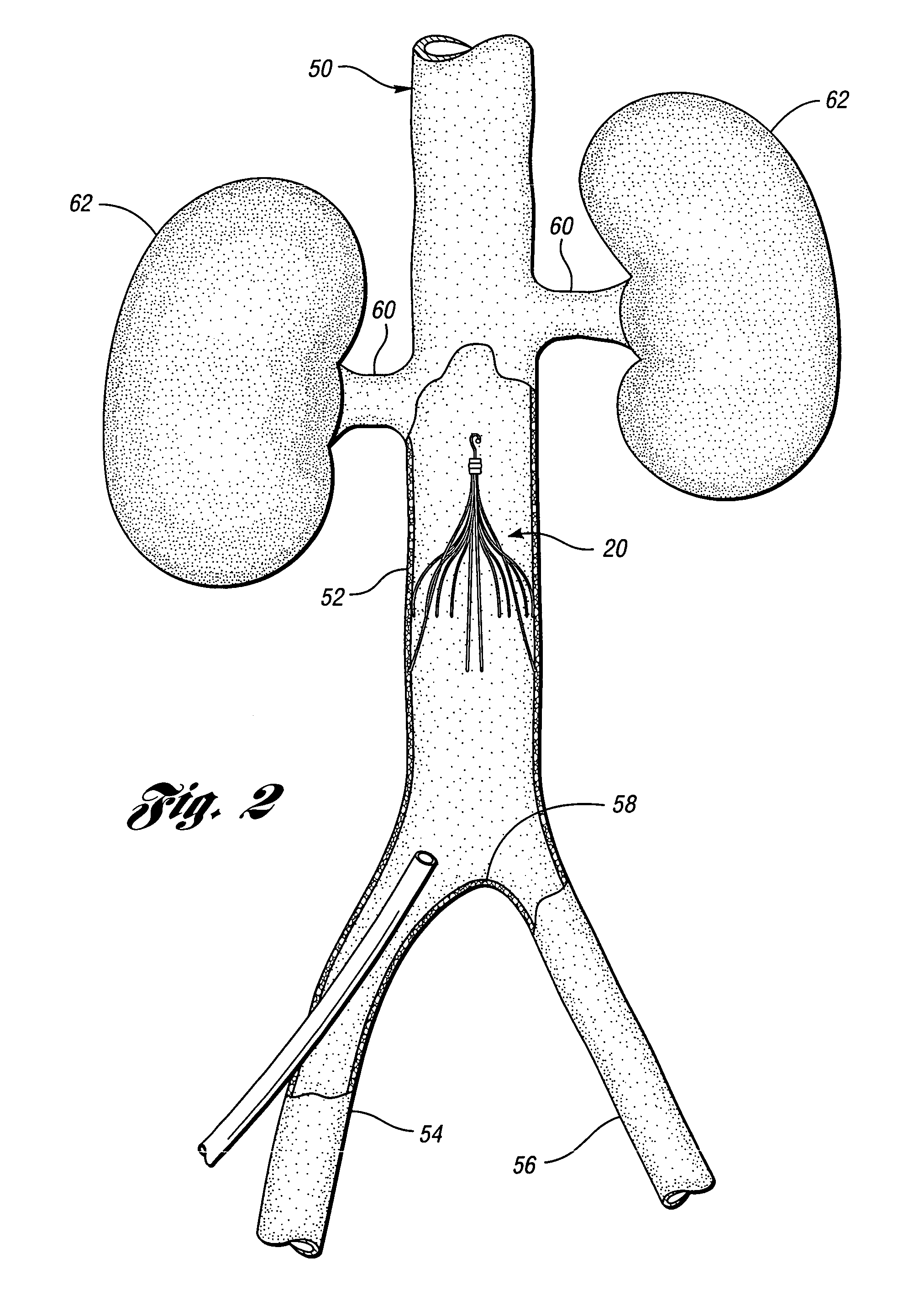 Removable vena cava filter