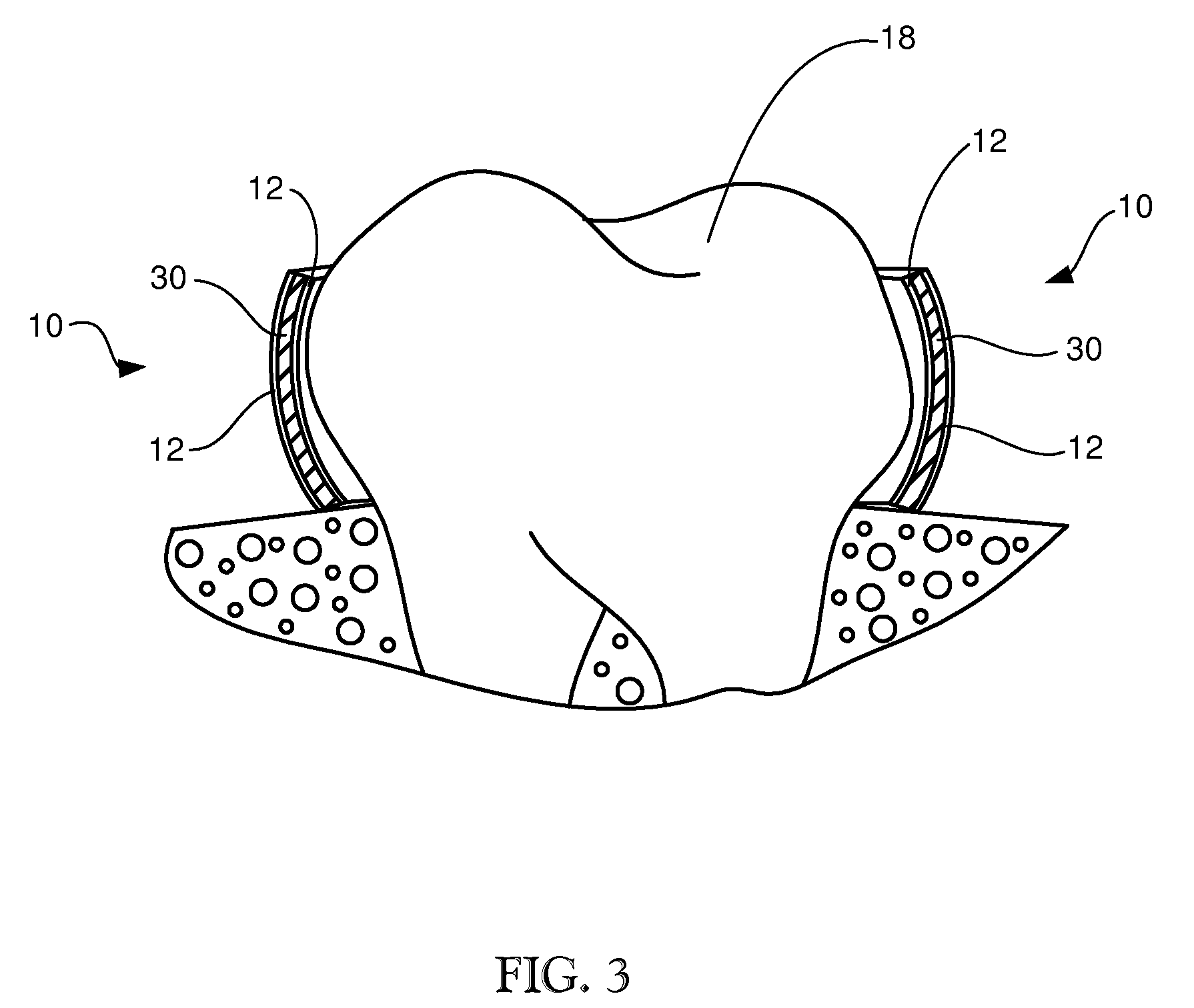 Dental matrix band