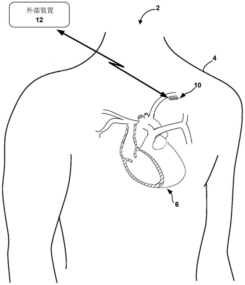 Sensing for heart failure management