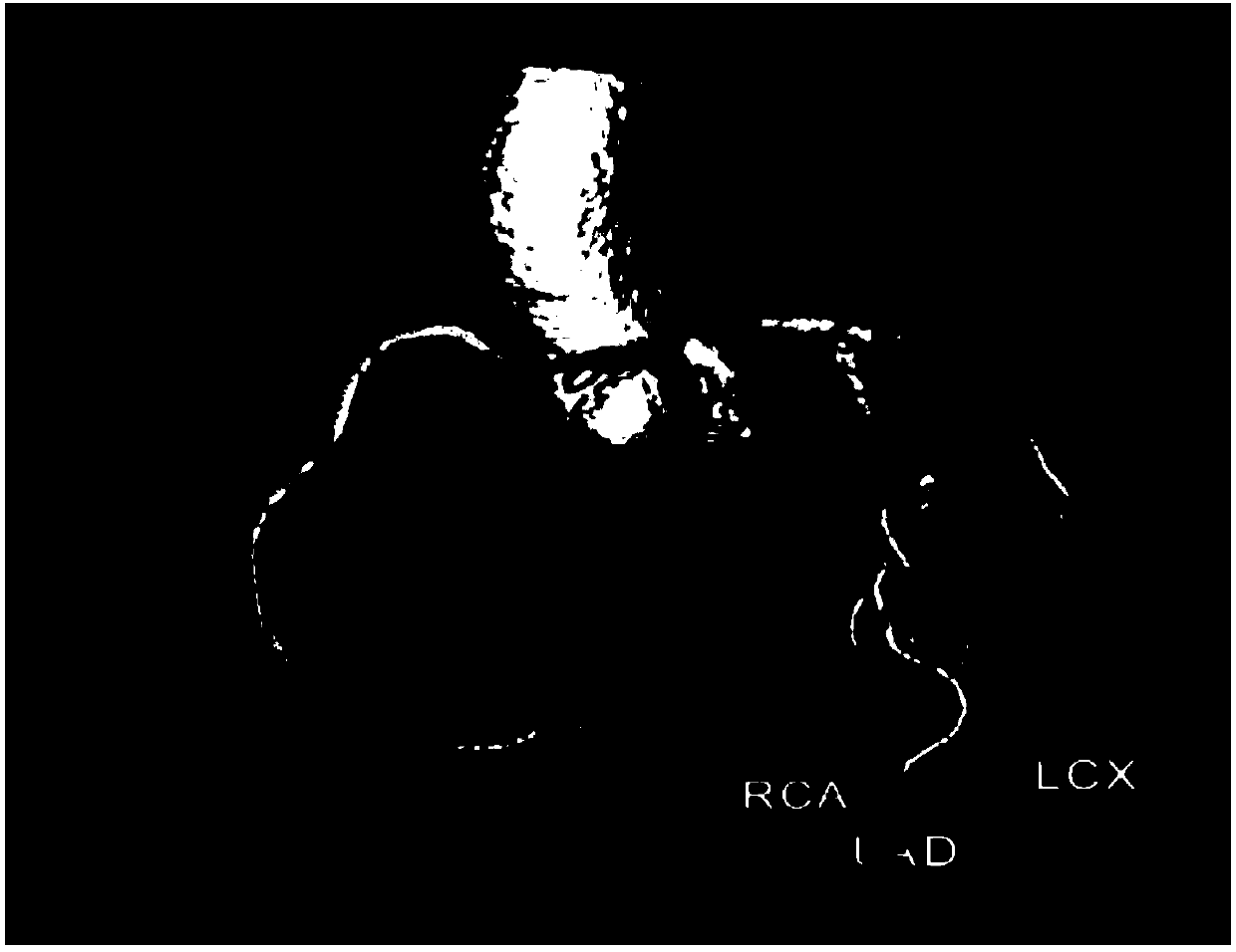 Blood vessel straightening and reconstructing method based on heart CT image