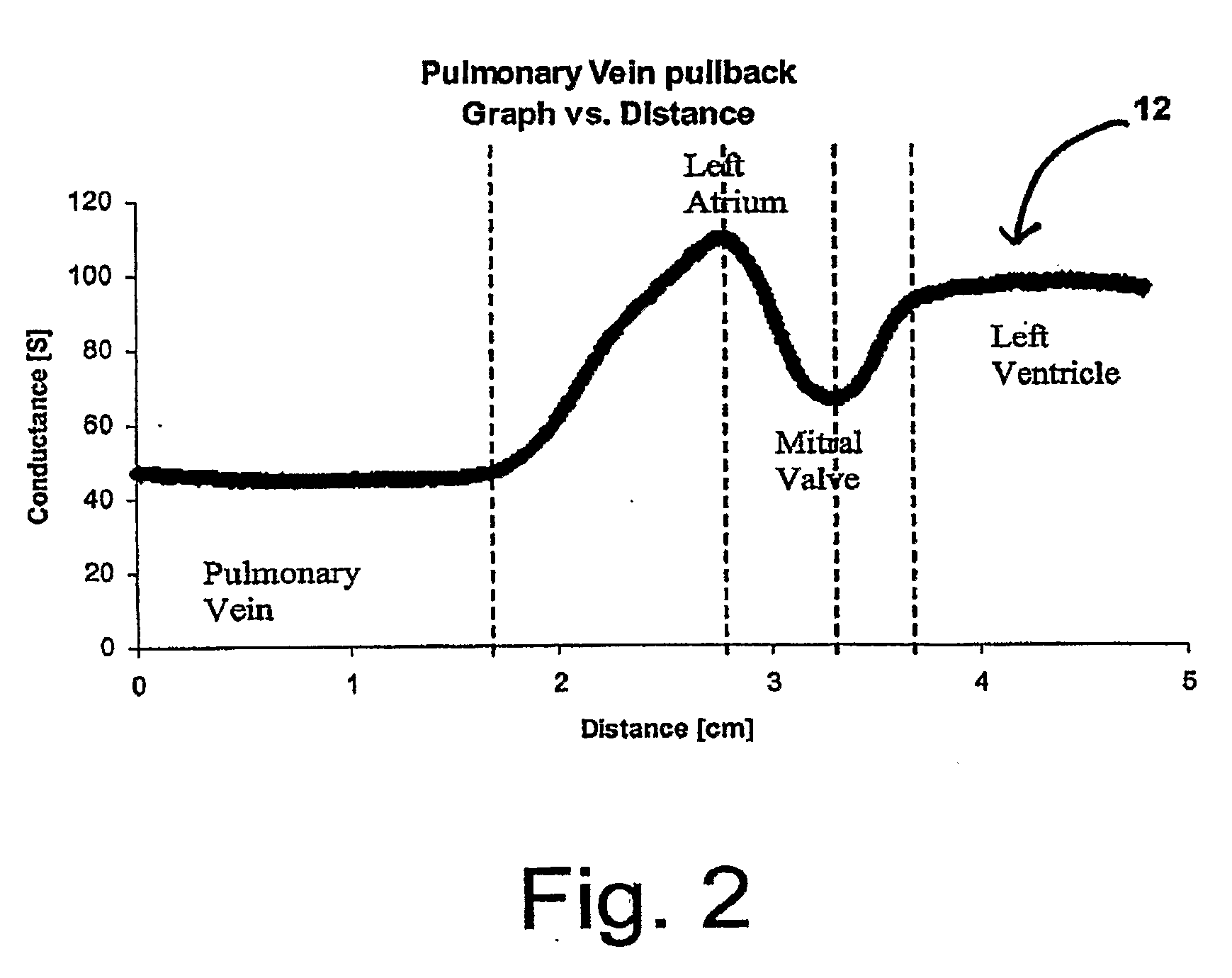 Localization of body lumen junctions