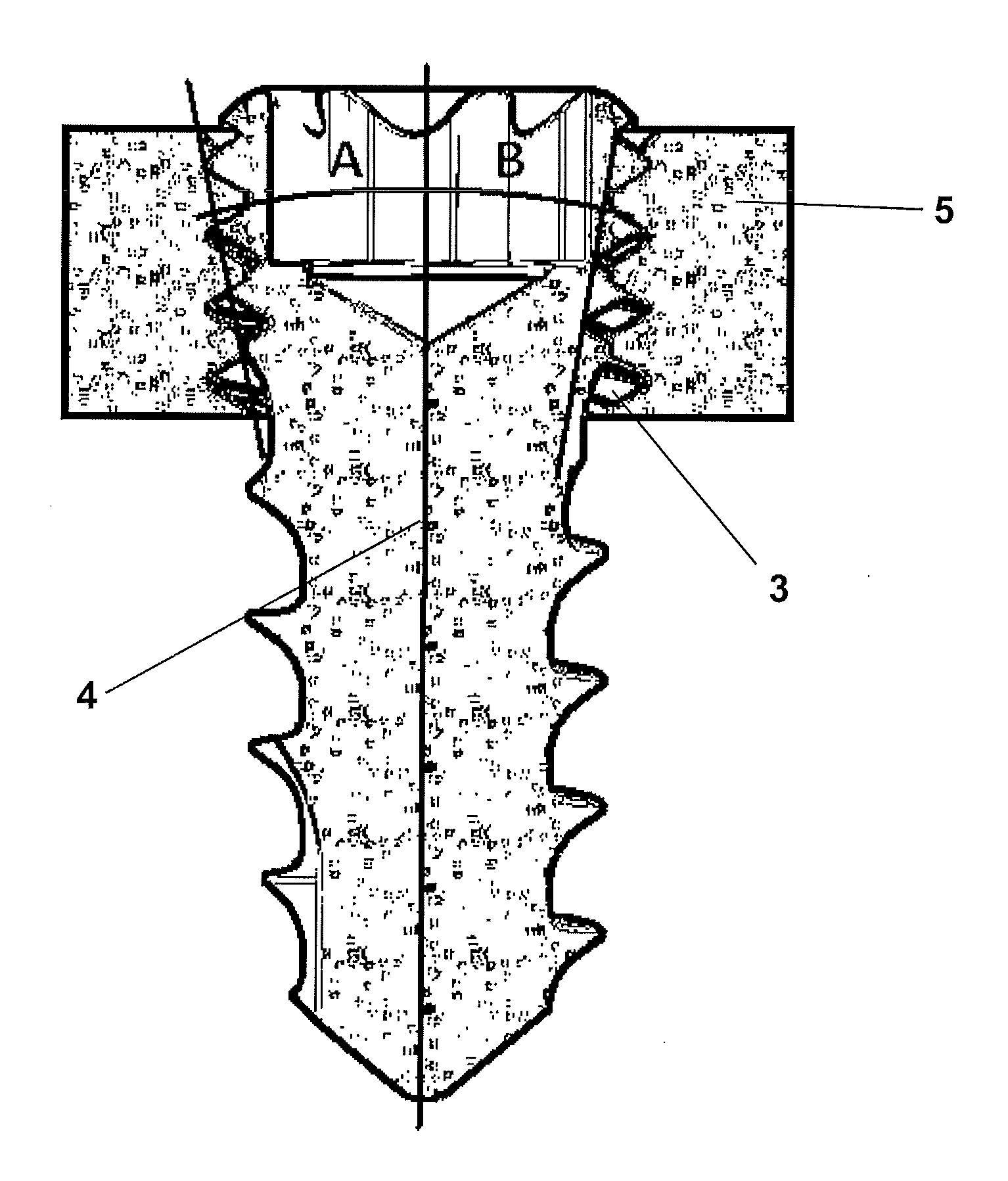 Blocked bone plate and screw provided with a threaded conic or parabolic head and arrangement comprising an implant and respective insertion method of said implant to a bone tissue