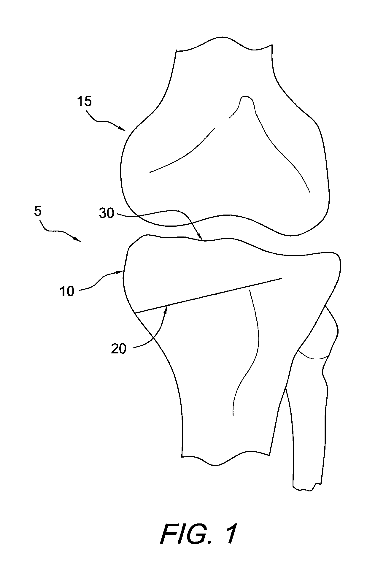 Method and apparatus for performing an open wedge, high tibial osteotomy