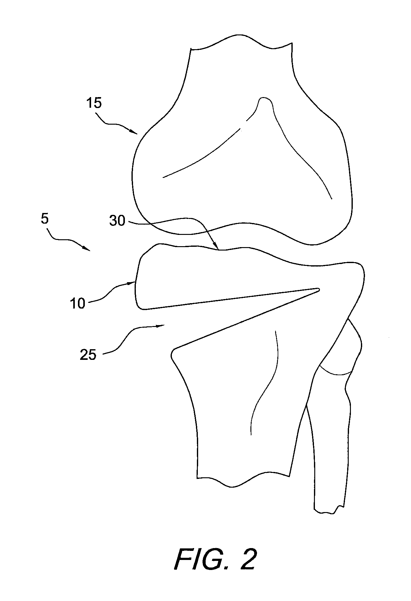 Method and apparatus for performing an open wedge, high tibial osteotomy