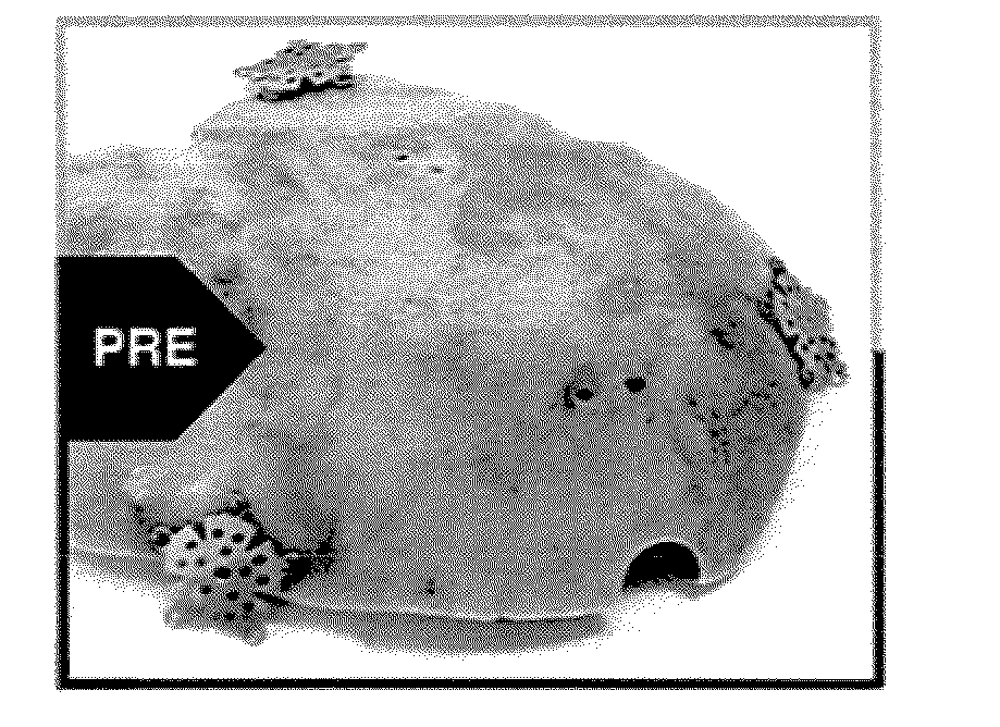 Methods for collecting and processing autografts, processed autografts, kits for collecting and transporting autografts, and tools for preparing autografts