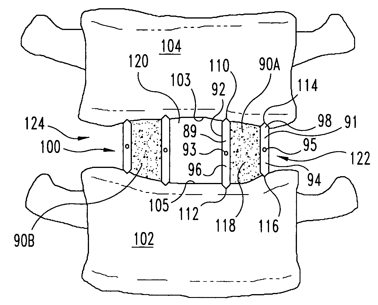 Reinforced molded implant formed of cortical bone