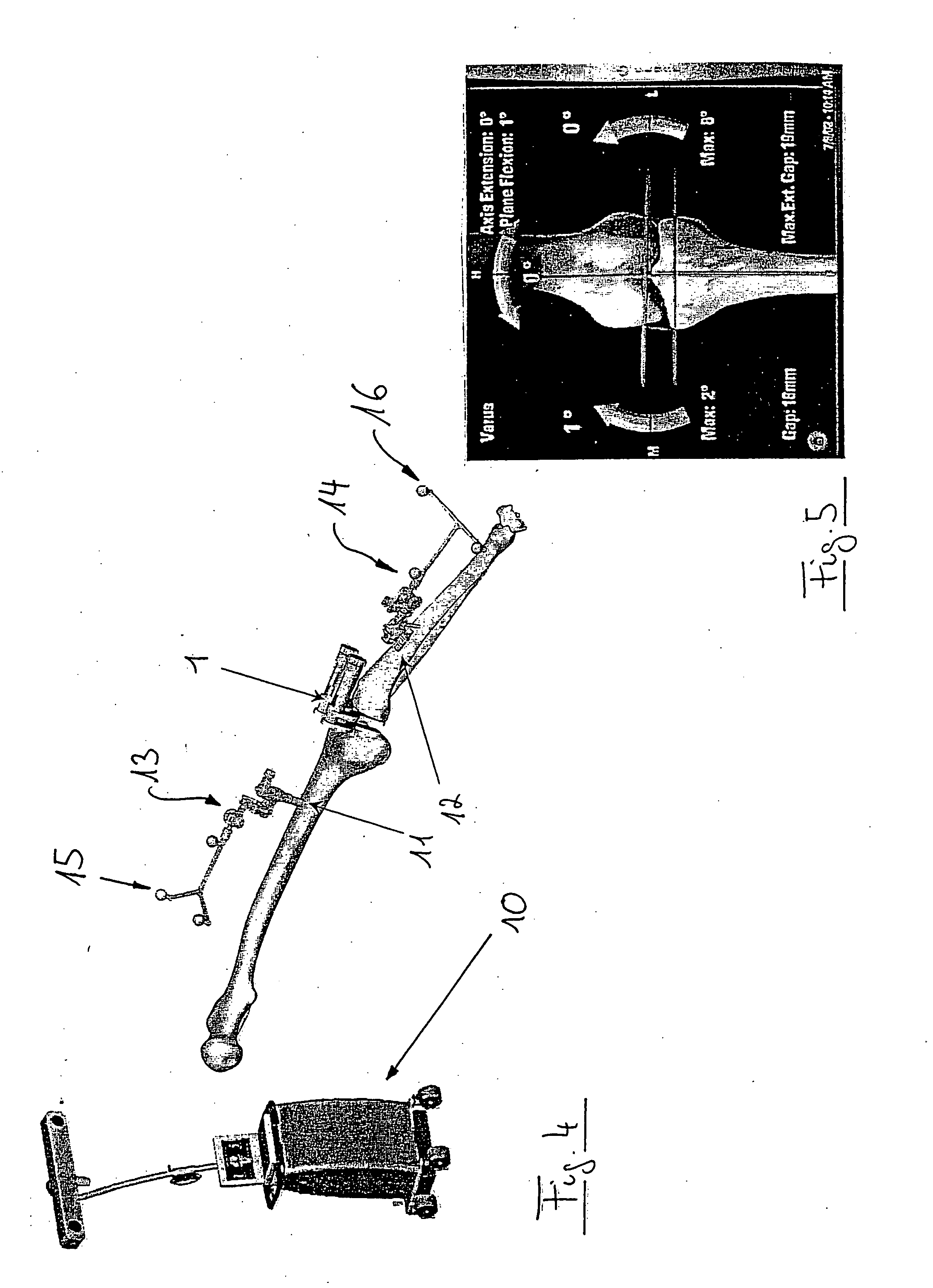 Ligament force detection system