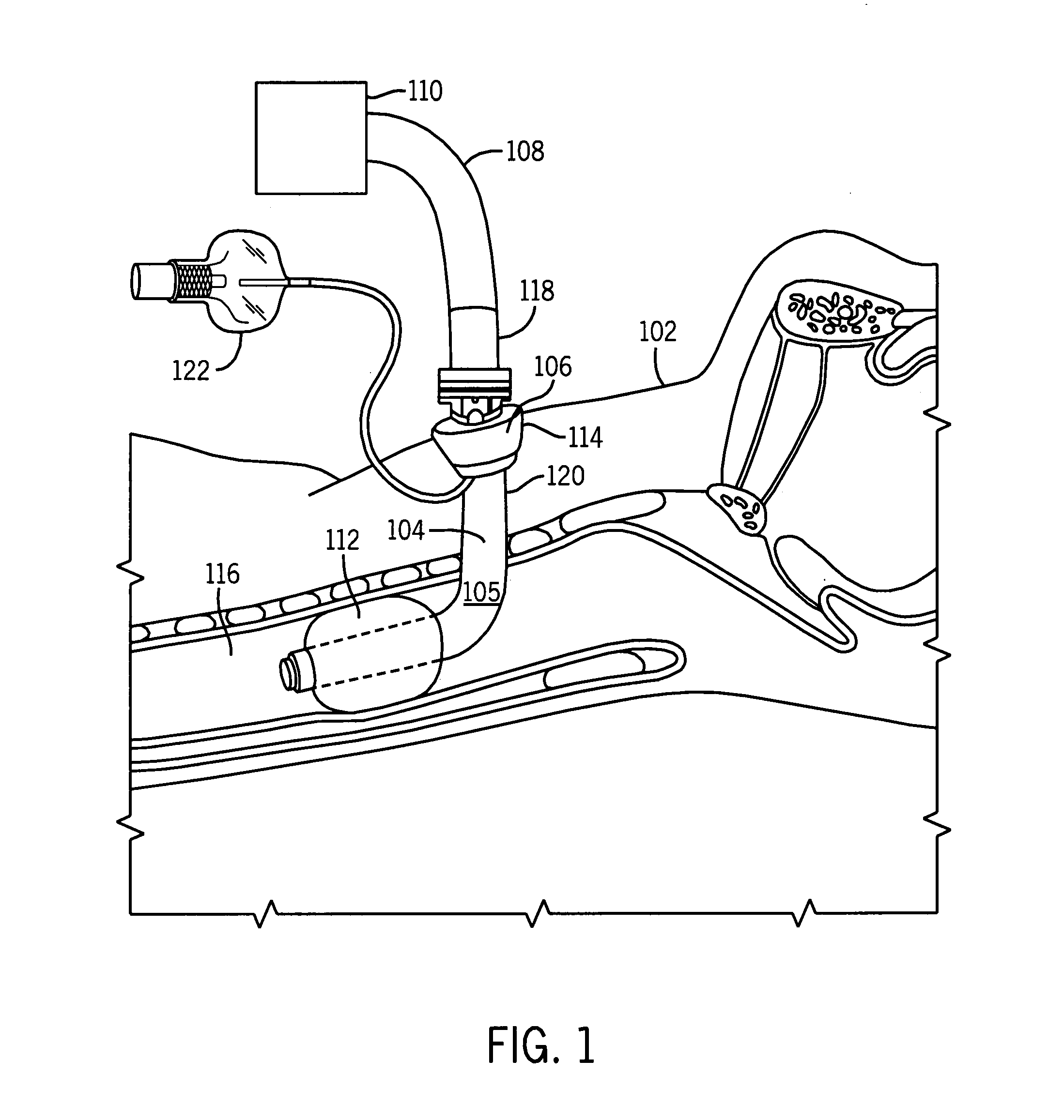 Tracheostomy tube connector key system